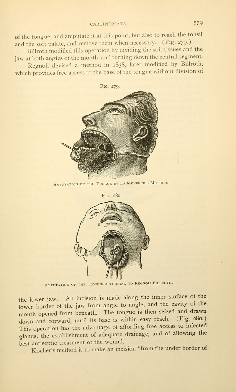 of the tongue, and amputate it at this point, but also to reach the tonsil and the soft palate, and remove them when necessary. (Fig. 279.) Billroth modified this operation by dividing the soft tissues and the jaw at both angles of the mouth, and turning down the central segment. Regnoli devised a method in 1838, later modified by Billroth, which provides free access to the base of the tongue without division of Fig. 279. Amputation of the Tonguk by Langenbeck's Method. Fig. 280. Amputatio N OF THE Tongue according to Regnoli-Billroth. the lower jaw. An incision is made along the inner surface of the lower border of the jaw from angle to angle, and the cavity of the mouth opened from beneath. The tongue is then seized and drawn down and forward, until its base is within easy reach. (Fig. 280.) This operation has the advantage of affording free access to infected glands, the establishment of adequate drainage, and of allowing the best antiseptic treatment of the wound. Kocher's method is to make an incision from the under border of