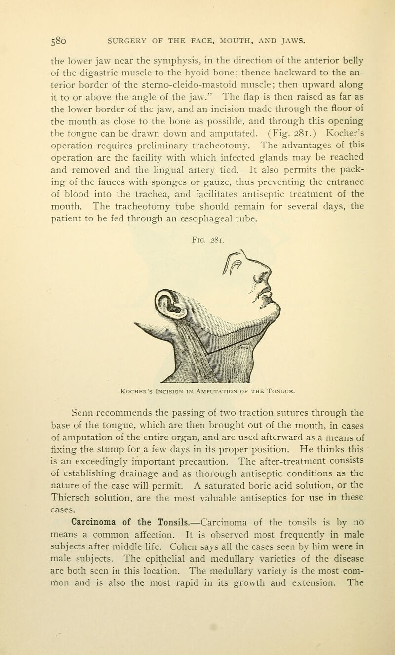 the lower jaw near the symphysis, in the direction of the anterior belly of the digastric muscle to the hyoid bone; thence backward to the an- terior border of the sterno-cleido-mastoid muscle; then upward along it to or above the angle of the jaw. The flap is then raised as far as the lower border of the jaw, and an incision made through the floor of the mouth as close to the bone as possible, and through this opening the tongue can be drawn down and amputated. (Fig. 281.) Kocher's operation requires preliminary tracheotomy. The advantages of this operation are the facility with which infected glands may be reached and removed and the lingual artery tied. It also permits the pack- ing of the fauces with sponges or gauze, thus preventing the entrance of blood into the trachea, and facilitates antiseptic treatment of the mouth. The tracheotomy tube should remain for several days, the patient to be fed through an oesophageal tube. Fig. 281. Kocher's Incision in Amputation of the Tongue. Senn recommends the passing of two traction sutures through the base of the tongue, which are then brought out of the mouth, in cases of amputation of the entire organ, and are used afterward as a means of fixing the stump for a few days in its proper position. He thinks this is an exceedingly important precaution. The after-treatment consists of establishing drainage and as thorough antiseptic conditions as the nature of the case will permit. A saturated boric acid solution, or the Thiersch solution, are the most valuable antiseptics for use in these cases. Carcinoma of the Tonsils.—Carcinoma of the tonsils is by no means a common afTection. It is observed most frequently in male subjects after middle life. Cohen says all the cases seen by him were in male subjects. The epithelial and medullary varieties of the disease are both seen in this location. The medullary variety is the most com- mon and is also the most rapid in its growth and extension. The