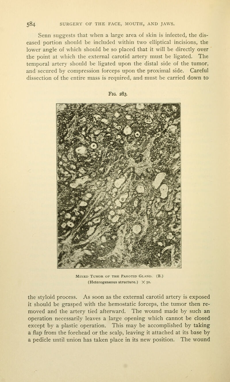 Senn suggests that when a large area of skin is infected, the dis- eased portion should be included within two elliptical incisions, the lower angle of which should be so placed that it will be directly over the point at which the external carotid artery must be ligated. The temporal artery should be ligated upon the distal side of the tumor, and secured by compression forceps upon the proximal side. Careful dissection of the entire mass is required, and must be carried down to Fig. 283. Mixed Tumor of the Parotid Gland. (Heterogeneous structure.) X 50. (B.) the styloid process. As soon as the external carotid artery is exposed it should be grasped with the hemostatic forceps, the tumor then re- moved and the artery tied afterward. The wound made by such an operation necessarily leaves a large opening which cannot be closed except by a plastic operation. This may be accomplished by taking a flap from the forehead or the scalp, leaving it attached at its base by a pedicle until union has taken place in its new position. The wound