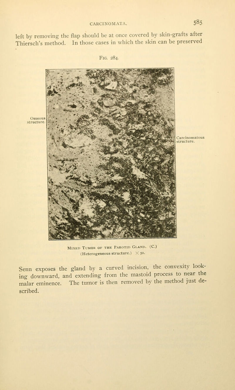 left by removing- the flap should be at once covered by skin-grafts after Thiersch's method. In those cases in which the skin can be preserved Fig. 284. Carcinomatous structure. Mixed Tumor of the Parotid Gland. (C.) (Heterogeneous structure.) X 5°- Senn exposes the gland by a curved incision, the convexity look- ing downward, and extending from the mastoid process to near the malar eminence. The tumor is then removed by the method just de- scribed.