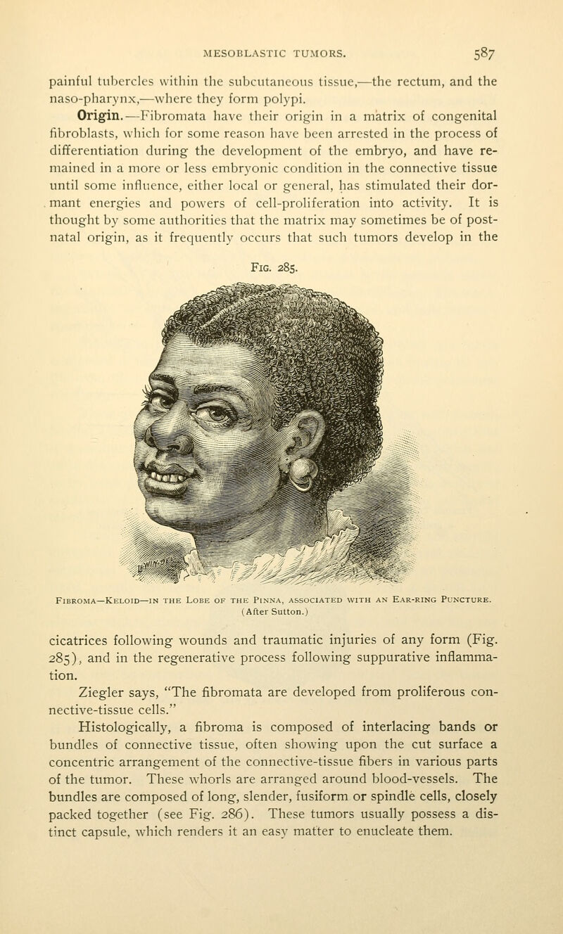 painful tnl)ercles within the subcutaneous tissue,—the rectum, and the naso-pharynx,—where they form polypi. Origin.—Fibromata have their origin in a matrix of congenital fibroblasts, which for some reason have been arrested in the process of differentiation during the development of the embryo, and have re- mained in a more or less embryonic condition in the connective tissue until some influence, either local or general, has stimulated their dor- mant energies and powers of cell-proliferation into activity. It is thought by some authorities that the matrix may sometimes be of post- natal origin, as it frequently occurs that such tumors develop in the Fig. 285. Fibroma—Keloid—IN the Lobe of the Pinna, associated with an Ear-ring Puncture. (After Sutton.) cicatrices following wounds and traumatic injuries of any form (Fig. 285), and in the regenerative process following suppurative inflamma- tion. Ziegler says, The fibromata are developed from proliferous con- nective-tissue cells. Histologically, a fibroma is composed of interlacing bands or bundles of connective tissue, often showing upon the cut surface a concentric arrangement of the connective-tissue fibers in various parts of the tumor. These whorls are arranged around blood-vessels. The bundles are composed of long, slender, fusiform or spindle cells, closely packed together (see Fig. 286). These tumors usually possess a dis- tinct capsule, which renders it an easy matter to enucleate them.