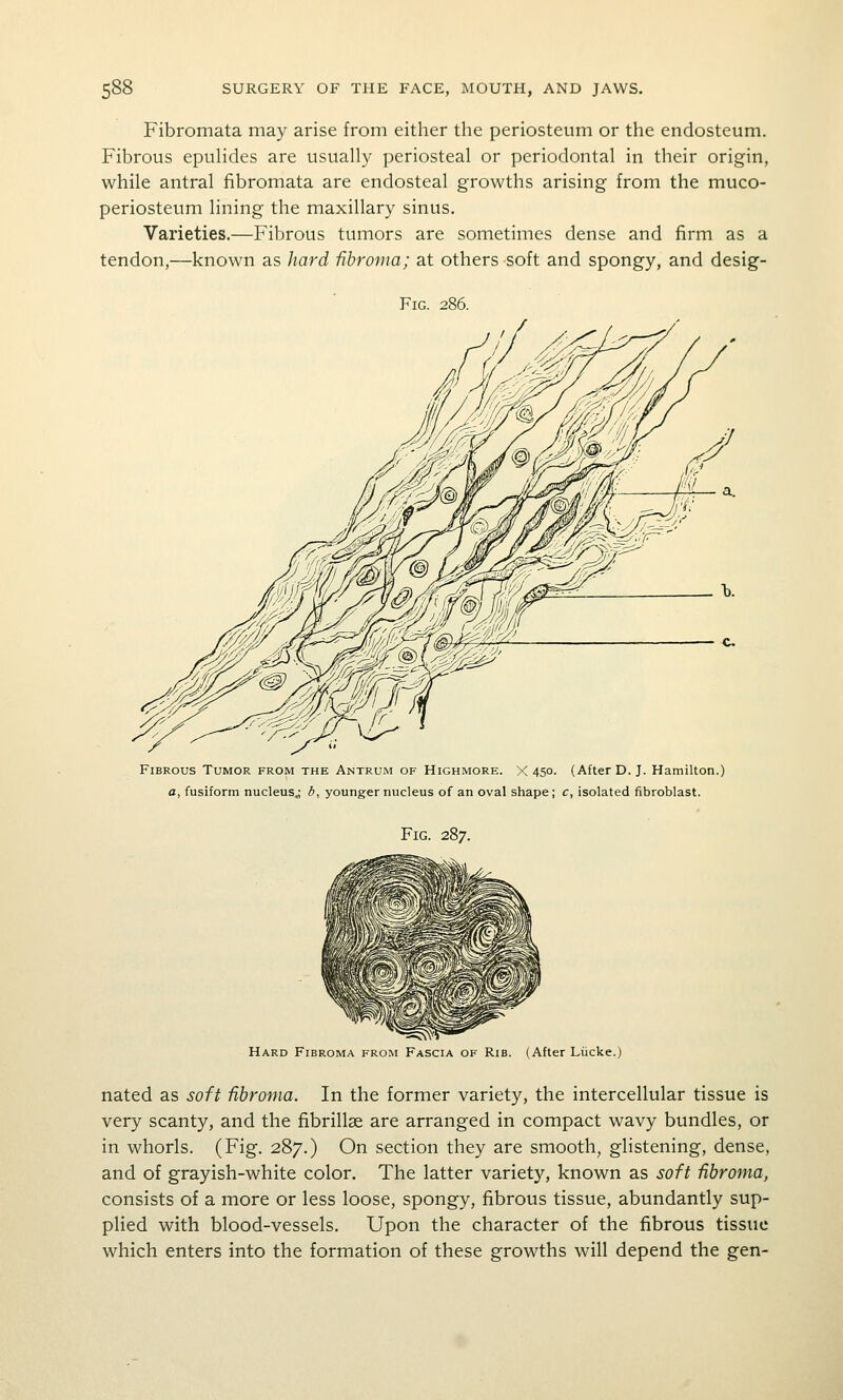 Fibromata may arise from either the periosteum or the endosteum. Fibrous epulides are usually periosteal or periodontal in their origin, while antral fibromata are endosteal growths arising from the muco- periosteum lining the maxillary sinus. Varieties.—Fibrous tumors are sometimes dense and firm as a tendon,—known as hard fibroma; at others soft and spongy, and desig- FlG. 286. Fibrous Tumor from the Antrum of Highmore. X 450. (After D.J. Hamilton.) a, fusiform nucleus.; d, youngernucleus of an oval shape; c, isolated fibroblast. Fig. 287. Hard Fibroma from Fascia of Rib. (After Liicke.) nated as soft fibroma. In the former variety, the intercellular tissue is very scanty, and the fibrillae are arranged in compact wavy bundles, or in whorls. (Fig. 287.) On section they are smooth, glistening, dense, and of grayish-white color. The latter variety, known as soft fibroma, consists of a more or less loose, spongy, fibrous tissue, abundantly sup- plied with blood-vessels. Upon the character of the fibrous tissue which enters into the formation of these growths will depend the gen-