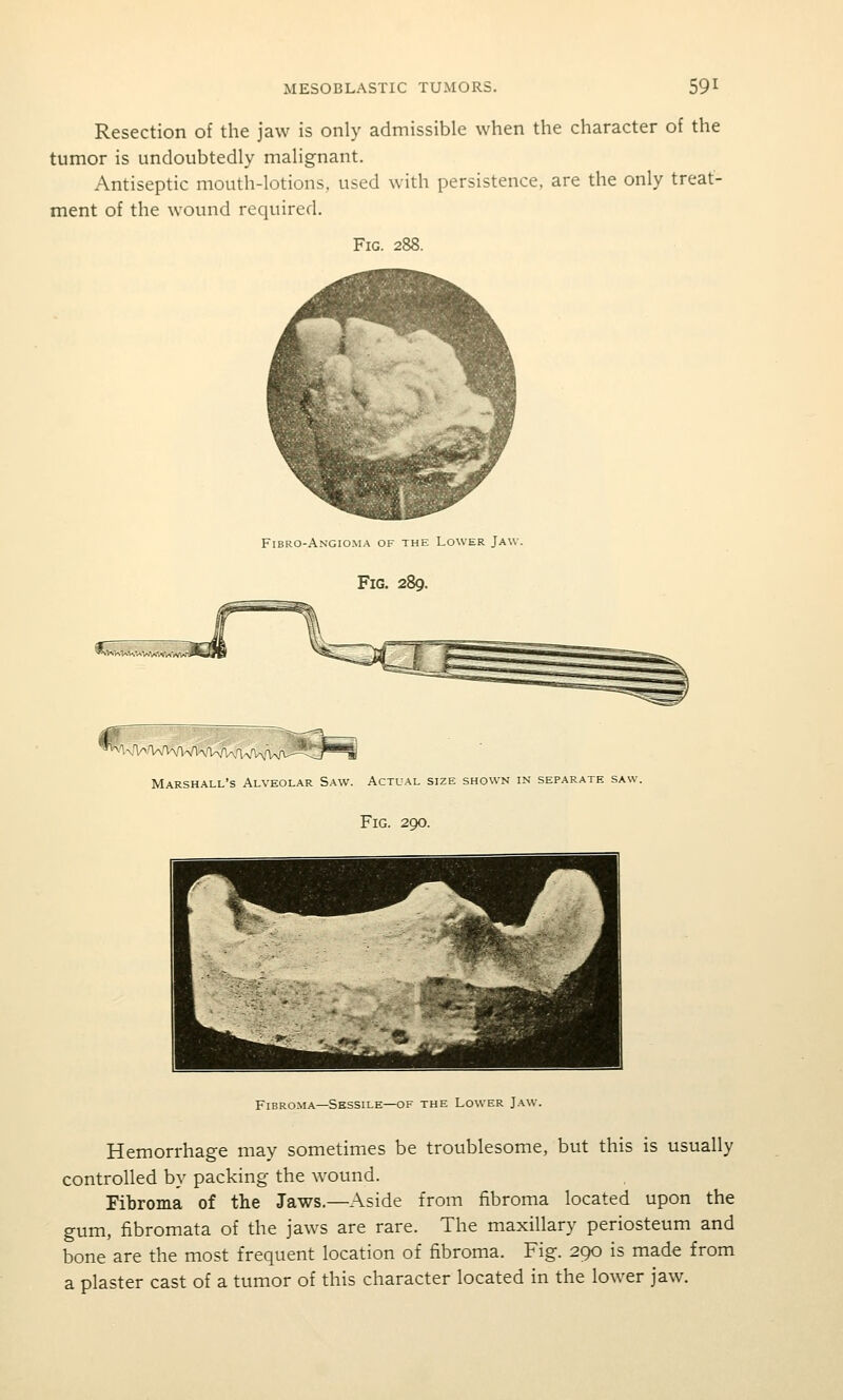 Resection of the jaw is only admissible when the character of the tumor is undoubtedly malignant. Antiseptic mouth-lotions, used with persistence, are the only treat- ment of the wound required. Fig. 288. Fibro-Angio.ma of the Lower Jaw. Fig. 289. Marshall's Alveolar Saw. Actual size shown in separate saw. Fig. 290. Fibroma—Sessile—OF the Lower Jaw. Hemorrhage may sometimes be troublesome, but this is usually controlled by packing the wound. Fibroma of the Jaws.—Aside from fibroma located upon the gum, fibromata of the jaws are rare. The maxillary periosteum and bone are the most frequent location of fibroma. Fig. 290 is made from a plaster cast of a tumor of this character located in the lower jaw.