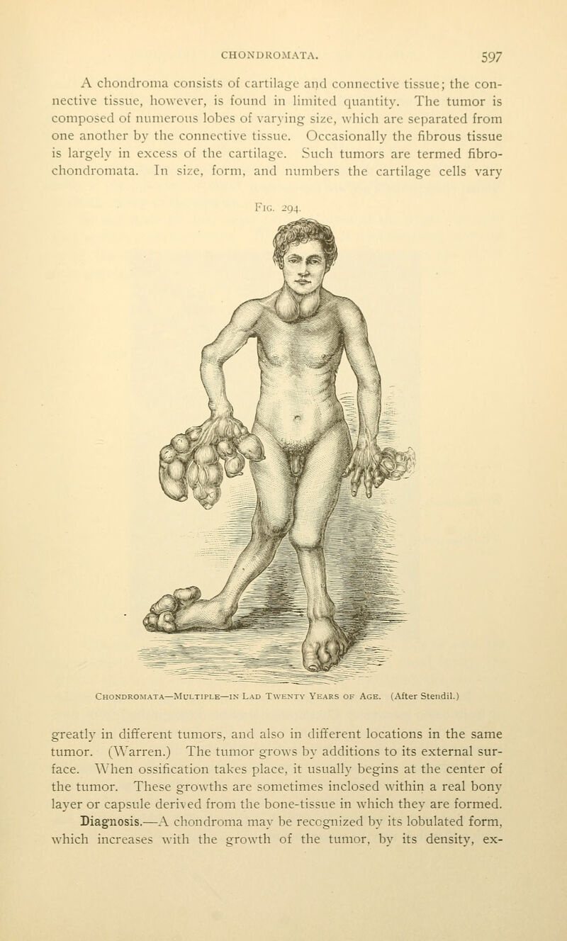 A chondroma consists of cartilage and connective tissue; the con- nective tissue, however, is found in Hmited cjuantity. The tumor is composed of numerous lobes of var}ing size, which are separated from one another by the connective tissue. Occasionally the fibrous tissue is largely in excess of the cartilage. Such tumors are termed fibro- chondromata. In size, form, and numbers the cartilage cells vary Fig. 294. Chondromata—Multiple—in Lad Twenty Years of Age. (After Stendil.) greatly in different tumors, and also in different locations in the same tumor. (Warren.) The tumor grows by additions to its external sur- face. When ossification takes place, it usually begins at the center of the tumor. These growths are sometimes inclosed within a real bony layer or capsule derived from the bone-tissue in which they are formed. Diagnosis.—A chondroma may be recognized by its lobulated form, which increases with the growth of the tumor, by its density, ex-