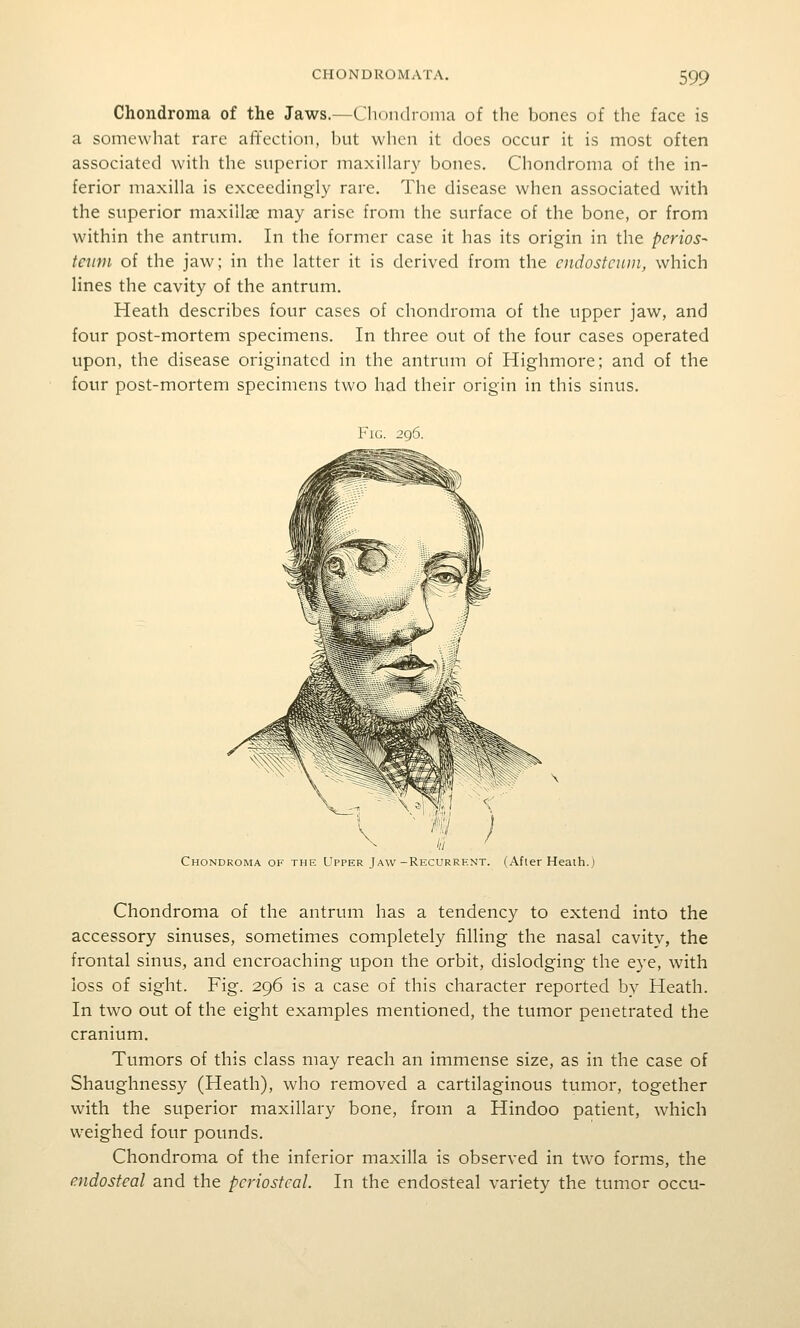 Chondroma of the Jaws.—Chondroma of the bones of the face is a somewhat rare alTection, but when it does occur it is most often associated with the superior maxillary bones. Chondroma of the in- ferior maxilla is exceedingly rare. The disease when associated with the superior maxilla? may arise from the surface of the bone, or from within the antrum. In the former case it has its origin in the perios- teum of the jaw; in the latter it is derived from the cndostcuni, which lines the cavity of the antrum. Heath describes four cases of chondroma of the upper jaw, and four post-mortem specimens. In three out of the four cases operated upon, the disease originated in the antrum of Highmore; and of the four post-mortem specimens two had their origin in this sinus. Fig 2q6 Chondroma of the Upper Jaw-Recurrent. (After Heath.) Chondroma of the antrum has a tendency to extend into the accessory sinuses, sometimes completely filling the nasal cavity, the frontal sinus, and encroaching upon the orbit, dislodging the eye, with loss of sight. Fig. 296 is a case of this character reported by Heath. In two out of the eight examples mentioned, the tumor penetrated the cranium. Tumors of this class may reach an immense size, as in the case of Shaughnessy (Heath), who removed a cartilaginous tumor, together with the superior maxillary bone, from a Hindoo patient, which weighed four pounds. Chondroma of the inferior maxilla is observed in two forms, the endosteal and the periosteal. In the endosteal variety the tumor occu-