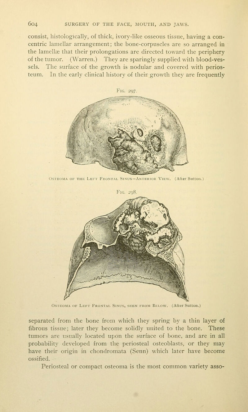 consist, histologically, of thick, ivory-like osseous tissue, having a con- centric lamellar arrangement; the bone-corpuscles are so arranged in the lamellae that their prolongations are directed toward the periphery of the tumor. (Warren.) They are sparingly supplied with blood-ves- sels. The surface of the growth is nodular and covered with perios- teum. In the early clinical history of their growth they are frequently Fig. 297. > \ Osteoma of the Left Frontal Sinus—Anterior View. (After Sutton.) Fig. 298. Osteoma of Left Frontal Sinus, seen from Below. (After Sutton.) separated from the bone from which they spring by a thin layer of fibrous tissue; later they become solidly united to the bone. These tumors are usually located upon the surface of bone, and are in all probability developed from the periosteal osteoblasts, or they may have their origin in chondromata (Senn) which later have become ossified. Periosteal or compact osteoma is the most common variety asso-