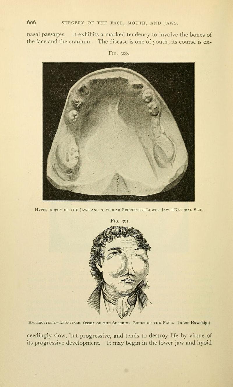 nasal passages. It exhibits a marked tendency to involve the bones of the face and the cranium. The disease is one of youth; its course is ex- Fic. 300. Hypertrophy of the Jaws and Alveolar Processes—Lower Jaw.—Natural Size. Fig. 301. Hyperostosis—Leontiasis Ossea of the Superior Bones of the Face. (After Howship.) ceedingly slow, but progressive, and tends to destroy life by virtue of its progressive development. It may begin in the lower jaw and hyoid