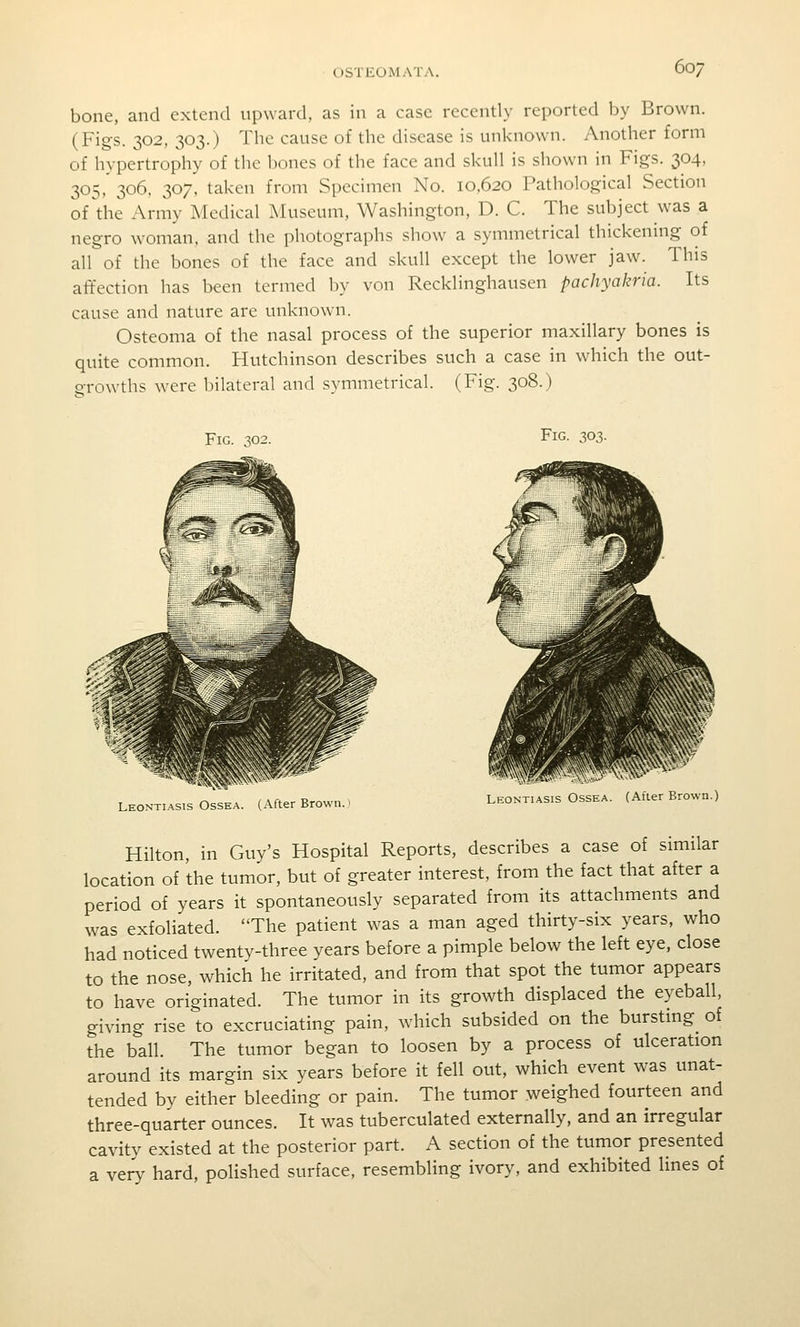 bone, and extend upward, as in a case recently reported by Brown. (Figs. 302, 303.) The cause of the disease is unknown. Another form of hypertrophy of the l)oncs of the face and skull is shown in Figs. 304, 305. 306, 307. taken from Specimen No. 10.620 Pathological Section of the Army Medical Museum, Washington, D. C. The subject was a negro Avoman. and the photographs show a symmetrical thickening of all of the bones of the face and skull except the lower jaw. This affection has been termed by von Recklinghausen pachyakria. Its cause and nature are unknown. Osteoma of the nasal process of the superior maxillary bones is quite common. Hutchinson describes such a case in which the out- growths were bilateral and symmetrical. (Fig. 308.) Fig. W2. Fig. 303. Leontiasis Ossea. (After Brown. Leontiasis OssEA. (Atier Brown.) Hilton, in Guy's Hospital Reports, describes a case of similar location of the tumor, but of greater interest, from the fact that after a period of years it spontaneously separated from its attachments and was exfoliated. The patient was a man aged thirty-six years, who had noticed twenty-three years before a pimple below the left eye, close to the nose, which he irritated, and from that spot the tumor appears to have originated. The tumor in its growth displaced the eyeball, giving rise to excruciating pain, which subsided on the burstmg of the ball. The tumor began to loosen by a process of ulceration around its margin six years before it fell out, which event was unat- tended by either bleeding or pain. The tumor weighed fourteen and three-quarter ounces. It was tuberculated externally, and an irregular cavity existed at the posterior part. A section of the tumor presented a very hard, polished surface, resembling ivory, and exhibited lines of