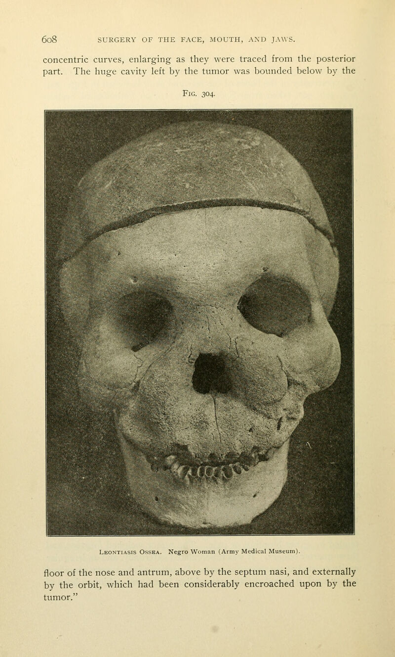 concentric curves, enlarging as they were traced from the posterior part. The huge cavity left by the tumor was bounded below by the Fig. 304. Leontiasis OssEA. Negro Woman (Army Medical Museum). floor of the nose and antrum, above by the septum nasi, and externally by the orbit, which had been considerably encroached upon by the tumor.