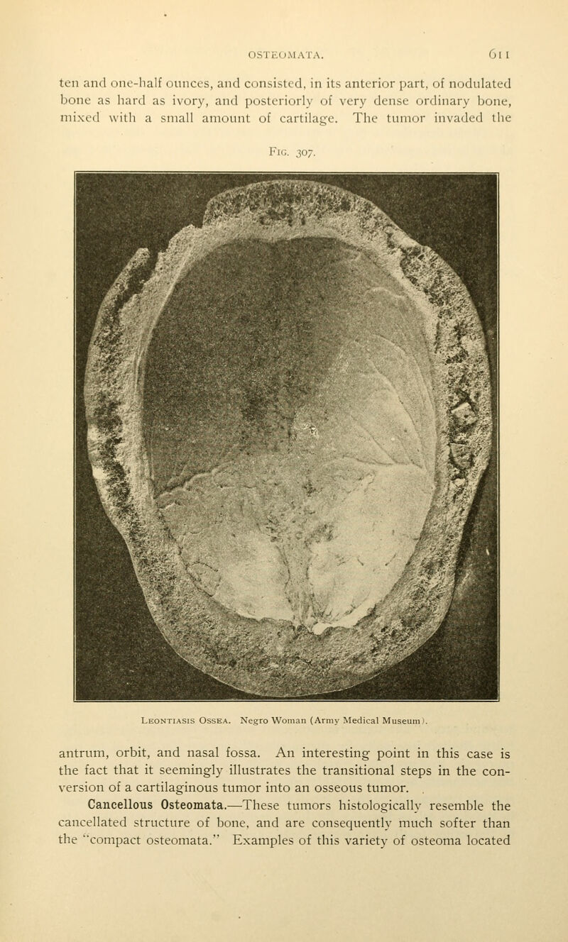 ten and one-half ounces, and consisted, in its anterior part, of nodulated bone as hard as ivory, and posteriorly of very dense ordinary bone, mixed with a small amount of cartilage. The tumor invaded the Fig. 307. Leontiasis Ossea. Negro Woman (Army Medical Museum*. antrum, orbit, and nasal fossa. An interesting point in this case is the fact that it seemingly illustrates the transitional steps in the con- version of a cartilaginous tumor into an osseous tumor. Cancellous Osteomata.—These tumors histologically resemble the cancellated structure of bone, and are consequently much softer than the compact osteomata. Examples of this variety of osteoma located