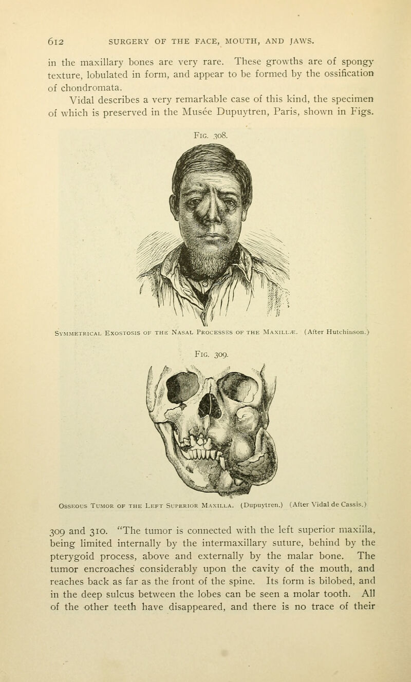 in the maxillary bones are very rare. These growths are of spongy- texture, lobulated in form, and appear to be formed by the ossification of chondromata. Vidal describes a very remarkable case of this kind, the specimen of which is preserved in the Musee Dupuytren, Paris, shown in Figs. Fig. 308. Symmetrical Exostosis of the Nasal Processes of the Maxill/e. (After Hutchinson.) Fig 309 Osseous Tumor of the Left Superior Maxilla. (Dupuytren.) (After Vidal de Cassis.) 309 and 310. The tumor is connected with the left superior maxilla, being limited internally by the intermaxillary suture, behind by the pterygoid process, above and externally by the malar bone. The tumor encroaches considerably upon the cavity of the mouth, and reaches back as far as the front of the spine. Its form is bilobed, and in the deep sulcvis between the lobes can be seen a molar tooth. All of the other teeth have disappeared, and there is no trace of their