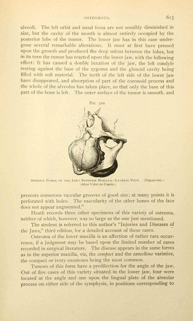 alveoli. The left orbit and nasal fossa arc not sensibly diminished in size, but the cavity of the moutii is almost entirely occupied by the posterior lobe of the lunior. The lower jaw has in this case under- gone several remarkable alterations. It must at first have pressed upon the growth and produced t-he deep sulcus between the lobes, but in its turn the tumor has reacted upon the lower jaw, with the following eflfect: It has caused a double luxation of the jaw, the left condyle resting against the base of the zygoma and the glenoid cavity being filled with soft material. The teeth of the left side of the lower jaw have disappeared, and absorption of part of the coronoid process and the whole of the alveolus has taken place, so that only the base of this part of the bone is left. The outer surface of the tumor is smooth, and Fig. 310. Osseous Tumor of the Left Superior Maxilla—Lateral View. (Dupuytren.) (After Vidal de Cassis.) presents numerous vascular grooves of good size; at many points it is perforated with holes. The vascularity of the other bones of the face does not appear augmented. Heath records three other specimens of this variety of osteoma, neither of which, however, was so large as the one just mentioned. The student is referred to this author's Injuries and Diseases of the Jaws, third edition, for a detailed account of these cases. Osteoma of the lower maxilla is an affection of rather rare occur- rence, if a judgment may be based upon the limited number of cases recorded in surgical literature. The disease appears in the same forms as in the superior maxilla, viz, the compact and the cancellous varieties, the compact or ivor\^ exostoses being the most common. Tumors of this form have a predilection for the angle of the jaw. Out of five cases of this variety situated in the lower jaw, four were located at the angle and one upon the lingual plate of the alveolar process on either side of the symphysis, in positions corresponding to