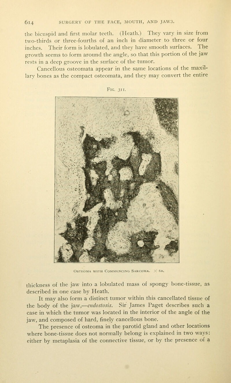 the bicuspid and first molar teeth. (Heath.) They vary in size from two-thirds Or three-fourths of an inch in diameter to three or four inches. Their form is lobulated, and they have smooth surfaces. The growth seems to form around the angle, so that this portion of the jaw rests in a deep groove in the surface of the tumor. Cancellous osteomata appear in the same locations of the maxil- lary bones as the compact osteomata, and they may convert the entire Fig. 311. Osteoma with Commkncing Sarcoma. X 60. thickness of the jaw into a lobulated mass of spongy bone-tissue, as described in one case by Heath. It may also form a distinct tumor within this cancellated tissue of the body of the jaw,—endostosis. Sir James Paget describes such a case in which the tumor was located in the interior of the angle of the jaw, and composed of hard, finely cancellous bone. The presence of osteoma in the parotid gland and other locations where bone-tissue does not normally belong is explained in two ways: either by metaplasia of the connective tissue, or by the presence of a