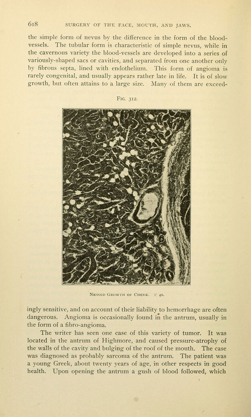 the simple form of nevus by the difiference in the form of the blood- vessels. The tubular form is characteristic of simple nevus, while in the cavernous variety the blood-vessels are developed into a series of variously-shaped sacs or cavities, and separated from one another only by fibrous septa, lined with endothelium. This form of angioma is rarely congenital, and usually appears rather late in life. It is of slow growth, but often attains to a large size. Many of them are exceed- FiG. 312. Nevoid Growth of Cheek. X 40. ingly sensitive, and on account of their liability to hemorrhage are often dangerous. Angioma is occasionally found in the antrum, usually in the form of a fibro-angioma. The writer has seen one case of this variety of tumor. It was located in the antrum of Highmore, and caused pressure-atrophy of the walls of the cavity and bulging of the roof of the mouth. The case was diagnosed as probably sarcoma of the antrum. The patient was a young Greek, about twenty years of age, in other respects in good health. Upon opening the antrum a gush of blood followed, which