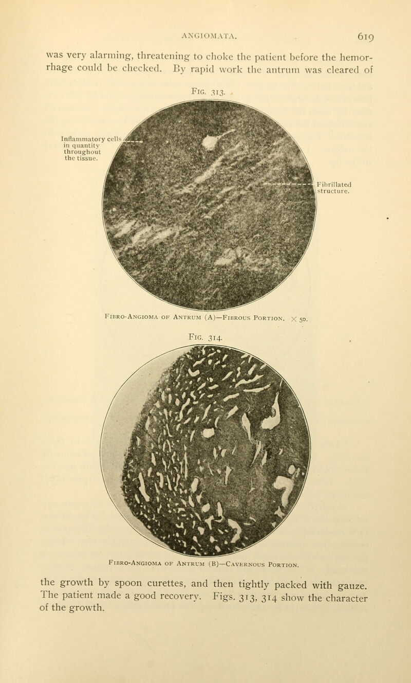 was very alarming, threatening to choke the patient before the hemor- rhage conld be checked. By rapid work the antrum was cleared of Fig. 313. Fibro-Angioma of Antrum (A)—Fibrous Portion, x 50. Fig. 314. Fibro-Angioma of Antrum (B)—CAvtRNOus Portion. the growth by spoon curettes, and then tightly packed with gauze. The patient made a good recovery. Figs. 313, 314 show the character of the growth.