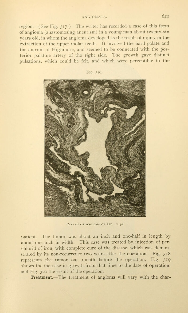 region. (See Fig'. 317.) The writer has recorded a case of this form of angioma (anastomosing aneurism) in a young man about twenty-six years old, in whom the angioma developed as the result of injury in the extraction of the upper molar teeth. It involved the hard palate and the antrum of Highmore, and seemed to be connected with the pos- terior palatine artery of the right side. The growth gave distinct pulsations, which could be felt, and which were perceptible to the Fig. .316. Cavernous Angioma ok Lip. X 50. patient. The tumor was about an inch and one-half in length by about one inch in width. This case was treated by injection of per- chlorid of iron, with complete cure of the disease, which was demon- strated by its non-recurrence two years after the operation. Fig. 318 represents the tumor one month before the operation. Fig. 319 shows the increase in growth from that time to the date of operation, and Fig. 320 the result of the operation. Treatment.—The treatment of angioma will varv with the char-