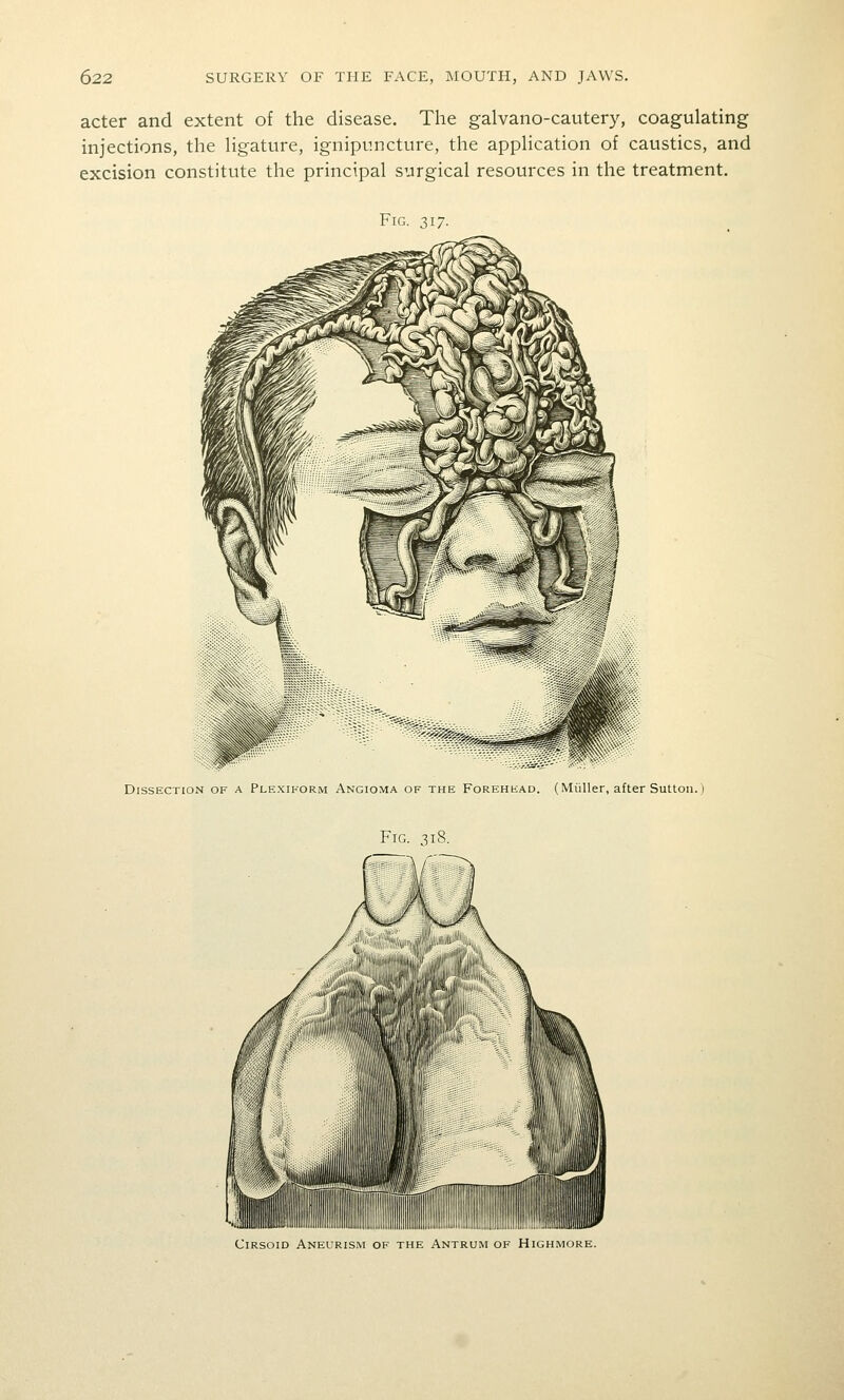 acter and extent of the disease. The galvano-cautery, coagulating injections, the hgature, ignipuncture, the appHcation of caustics, and excision constitute the principal surgical resources in the treatment. Fig. 317. DissECTicvor A Pi rxitoRM VncioM'^ of thi Forhhi ad (Miiller ifter Sutton. 1 Cirsoid Anelrism op the Antrum of Highmore.