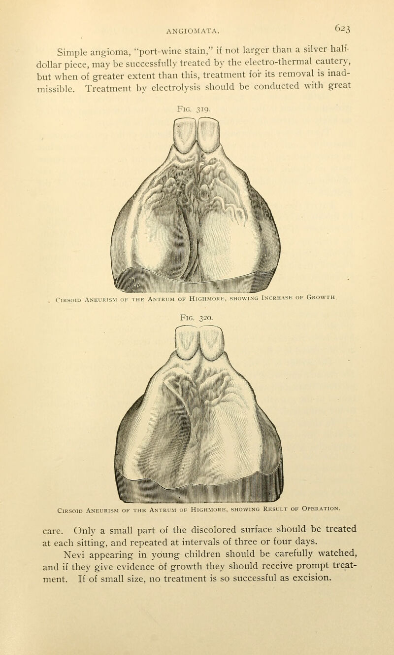 Simple angioma, port-wine stain, if not larger than a silver half- dollar piece, may be successfully treated by the electro-thermal cautery, but when of greater extent than this, treatment for its removal is inad- missible. Treatment by electrolysis should be conducted with great Fig. 319. Cirsoid Aneurism oi. the Antrum of HiGHMORt., showing Increa.se of Growth, Fig. 320. Cirsoid Aneurism of the Antrim of Highmore, showing Result of Operation. care. Only a small part of the discolored surface should be treated at each sitting, and repeated at intervals of three or four days. Nevi appearing in young children should be carefully watched, and if they give evidence of growth they should receive prompt treat- ment. If of small size, no treatment is so successful as excision.