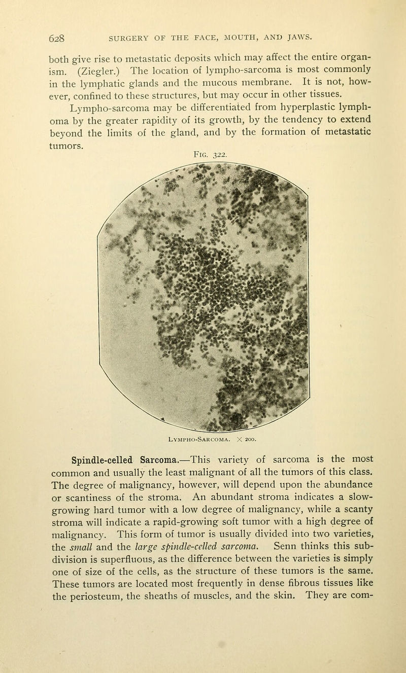 both give rise to metastatic deposits which may affect the entire organ- ism. (Ziegler.) The location of lympho-sarcoma is most commonly in the lymphatic glands and the mucous membrane. It is not, how- ever, confined to these structures, but may occur in other tissues. Lympho-sarcoma may be differentiated from hyperplastic lymph- oma by the greater rapidity of its growth, by the tendency to extend beyond the limits of the gland, and by the formation of metastatic tumors. Fig. 322. Lympho-Sarcoma. X 200. Spindle-celled Sarcoma.—This variety of sarcoma is the most common and usually the least malignant of all the tumors of this class. The degree of malignancy, however, will depend upon the abundance or scantiness of the stroma. An abundant stroma indicates a slow- growing hard tumor with a low degree of malignancy, while a scanty stroma will indicate a rapid-growing soft tumor with a high degree of malignancy. This form of tumor is usually divided into two varieties, the small and the large spindle-celled sarcoma. Senn thinks this sub- division is superfluous, as the difference between the varieties is simply one of size of the cells, as the structure of these tumors is the same. These tumors are located most frequently in dense fibrous tissues like the periosteum, the sheaths of muscles, and the skin. They are com-