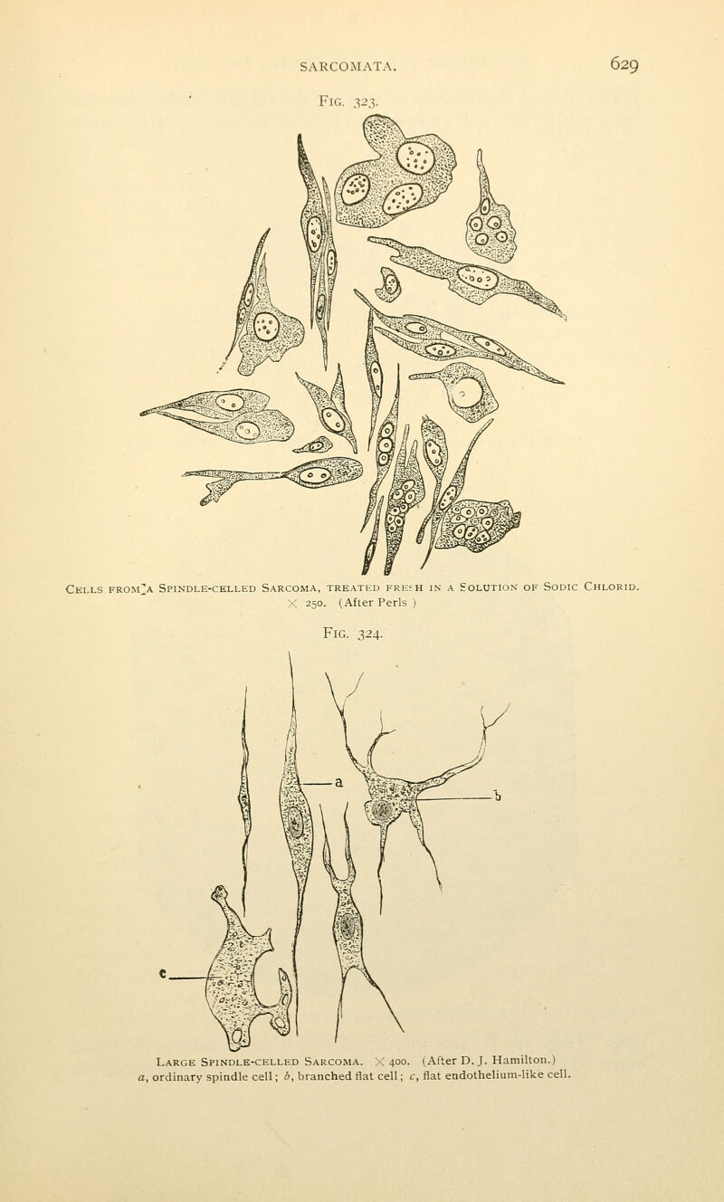 Fig. .-^23. Cells from^a Spindle-celled Sarcoma, treated fresh in a Solution of Sodic Chlorid. X 250. (After Perls ) Fig. 324. Large Spindle-celled Sarcoma. X 400. (After D. J. Hamilton.) a, ordinary spindle cell; b, branched flat cell; c, flat endothelium-like cell.