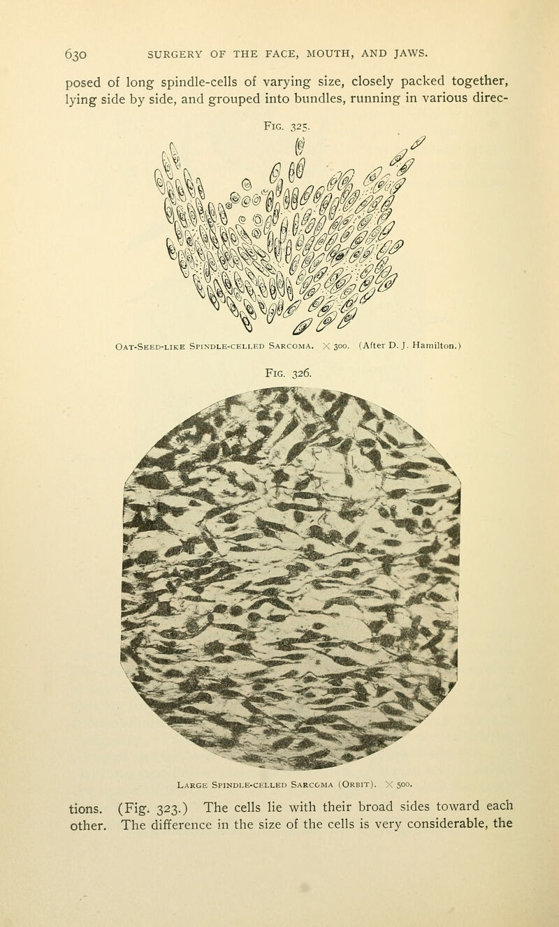 posed of long spindle-cells of varying size, closely packed together, lying side by side, and grouped into bundles, running in various direc- FiG. 325. I' ,^ Oat-Seed-like Spindle-celi.ed Sarcoma. X 300. (After D.J. Hamilton.) Fig. 326. Large Spindle-celled Sarcoma (Orbit). >C 500. tions. (Fig. 323.) The cells lie with their broad sides toward each other. The difference in the size of the cells is very considerable, the