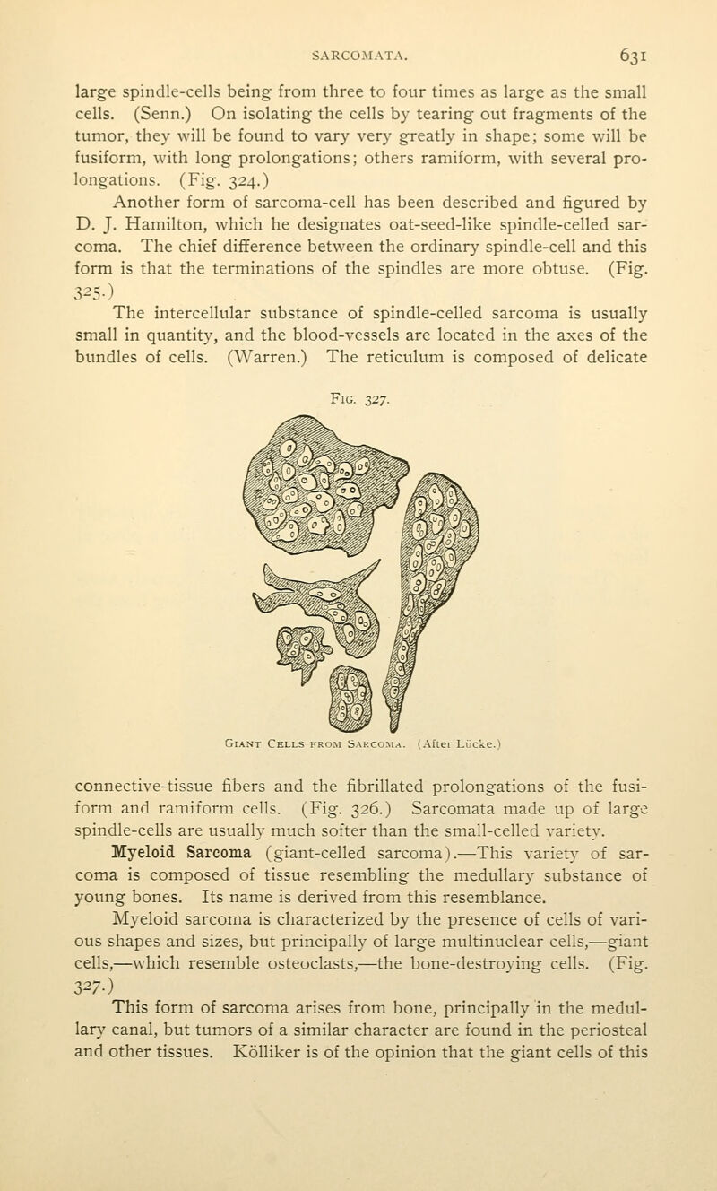 large spindle-cells being from three to four times as large as the small cells. (Senn.) On isolating the cells by tearing out fragments of the tumor, they ^vill be found to vary very greatly in shape; some will be fusiform, with long prolongations; others ramiform, with several pro- longations. (Fig. 324.) Another form of sarcoma-cell has been described and figured by D. J, Hamilton, which he designates oat-seed-like spindle-celled sar- coma. The chief difference between the ordinary spindle-cell and this form is that the terminations of the spindles are more obtuse. (Fig. 3^5-) The intercellular substance of spindle-celled sarcoma is usually small in quantity, and the blood-vessels are located in the axes of the bundles of cells. (Warren.) The reticulum is composed of delicate Fig. 327. Giant Cells from SAKCo^L•l. (Afier Liicke.) connective-tissue fibers and the fibrillated prolongations of the fusi- form and ramiform cells. (Fig. 326.) Sarcomata made up of large spindle-cells are usually much softer than the small-celled variety. Myeloid Sarcoma (giant-celled sarcoma).—This variety of sar- coma is composed of tissue resembling the medullary substance of young bones. Its name is derived from this resemblance. Myeloid sarcoma is characterized by the presence of cells of vari- ous shapes and sizes, but principally of large multinuclear cells,—giant cells,—which resemble osteoclasts,—the bone-destroying cells. (Fig. 327.) This form of sarcoma arises from bone, principally in the medul- lar}^ canal, but tumors of a similar character are found in the periosteal and other tissues. Kolliker is of the opinion that the giant cells of this