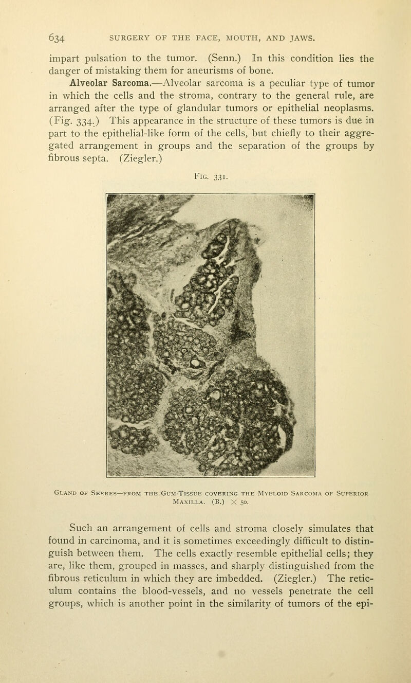 impart pulsation to the tumor. (Senn.) In this condition lies the danger of mistaking them for aneurisms of bone. Alveolar Sarcoma.—Alveolar sarcoma is a peculiar type of tumor in which the cells and the stroma, contrary to the general rule, are arranged after the type of glandular tumors or epithelial neoplasms. (Fig. 334.) This appearance in the structure of these tumors is due in part to the epithelial-like form of the cells, but chiefly to their aggre- gated arrangement in groups and the separation of the groups by fibrous septa. (Ziegler.) Fig. 3.11. Gland of Serres—from the Gum-Tissue covering the Myeloid Sarcoma of Superior Maxilla. (B.) X 50. Such an arrangement of cells and stroma closely simulates that found in carcinoma, and it is sometimes exceedingly difficult to distin- guish between them. The cells exactly resemble epithelial cells; they are, like them, grouped in masses, and sharply distinguished from the fibrous reticulum in which they are imbedded. (Ziegler.) The retic- ulum contains the blood-vessels, and no vessels penetrate the cell groups, which is another point in the similarity of tumors of the epi-