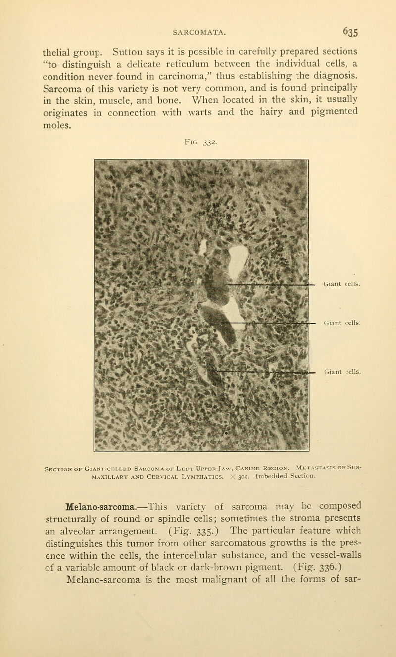 thelial group. Sutton says it is possible in carefully prepared sections to distinguish a delicate reticulum between the individual cells, a condition never found in carcinoma, thus establishing the diagnosis. Sarcoma of this variety is not very common, and is found principally in the skin, muscle, and bone. When located in the skin, it usually originates in connection with warts and the hairy and pigmented moles. Fig. 332. Giant cells. Giant cells. Giant cells. Section of Giant-celled Sarcoma of Left Upper Jaw, Canine Region. Metastasis of Sub- maxillary AND Cer\'ical Lymphatics. < 300. Imbedded Section. Melano-sarcoma.—This variety of sarcoma may be composed structurally of round or spindle cells; sometimes the stroma presents an alveolar arrangement. (Fig. 335.) The particular feature which distinguishes this tumor from other sarcomatous growths is the pres- ence within the cells, the intercellular substance, and the vessel-walls of a variable amount of black or dark-brown pigment. (Fig. 336.) Melano-sarcoma is the most malignant of all the forms of sar-