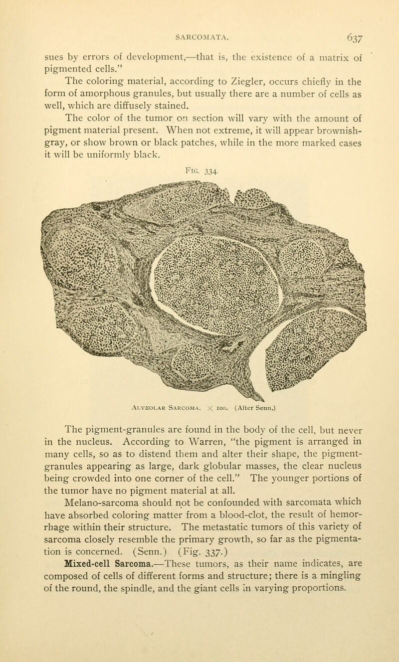 sues by errors of development,—that is, the existence of a matrix of pigmented cells. The coloring material, according to Ziegler, occurs chiefly in the form of amorphous granules, but usually there are a number of cells as well, v/hich are diffusely stained. The color of the tumor on section will vary with the amount of pigment material present. When not extreme, it will appear brownish- gray, or show brown or black patches, while in the more marked cases it will be uniformly black. Fig. 334. Alveolar S.^rcoma. X 100. (After Senn.) The pigment-granules are found in the body of the cell, but never in the nucleus. According to Warren, the pigment is arranged in many cells, so as to distend them and alter their shape, the pigment- granules appearing as large, dark globular masses, the clear nucleus being crowded into one corner of the cell. The younger portions of the tumor have no pigment material at all. Melano-sarcoma should not be confounded with sarcomata which have absorbed coloring matter from a blood-clot, the result of hemor- rhage within their structure. The metastatic tumors of this variety of sarcoma closely resemble the primary growth, so far as the pigmenta- tion is concerned. (Senn.) (Fig. 337.) Mixed-cell Sarcoma.—These tumors, as their name indicates, are composed of cells of different forms and structure; there is a mingling of the round, the spindle, and the giant cells in varying proportions.