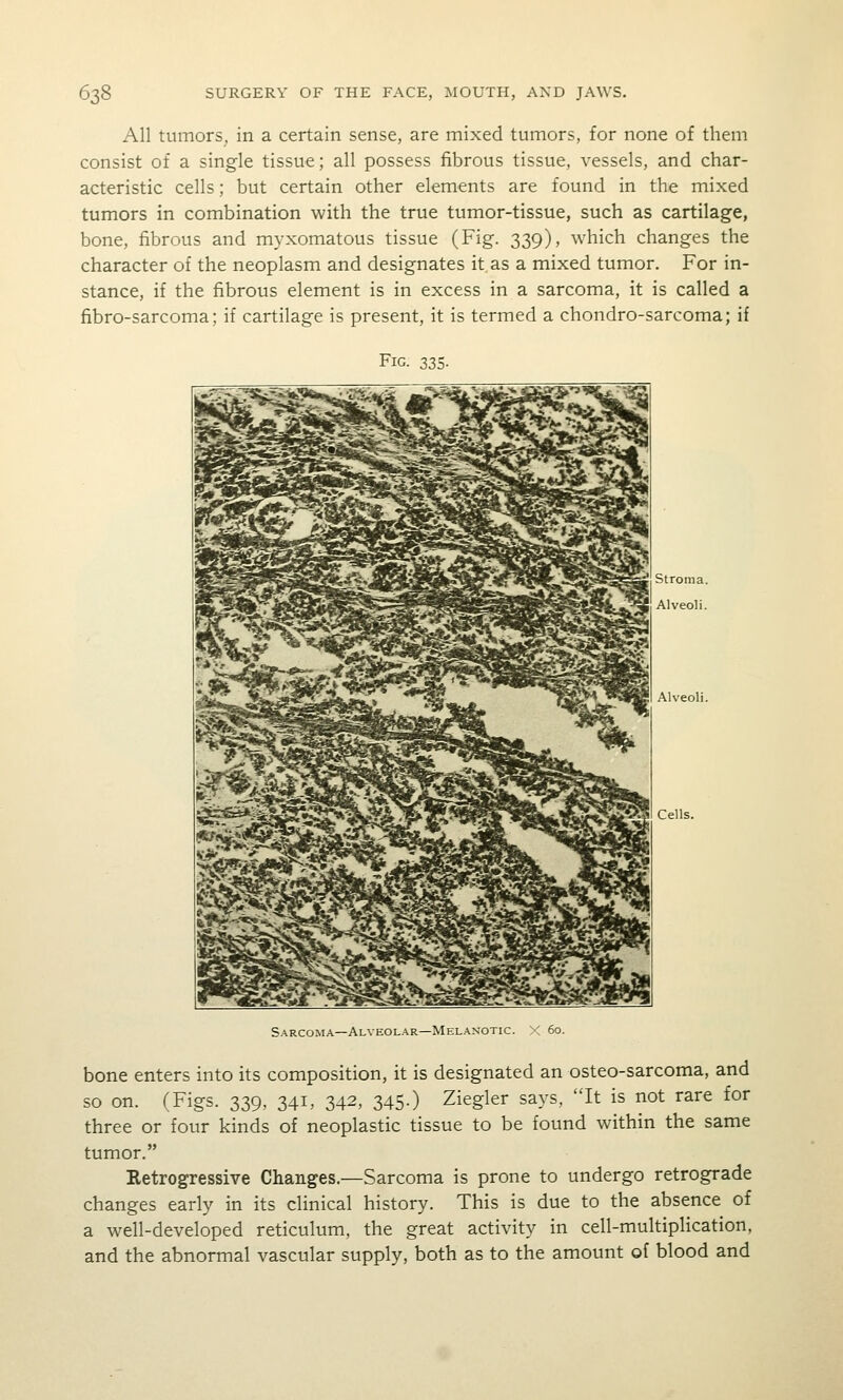 All tumors, in a certain sense, are mixed tumors, for none of them consist of a single tissue; all possess fibrous tissue, vessels, and char- acteristic cells; but certain other elements are found in the mixed tumors in combination with the true tumor-tissue, such as cartilage, bone, fibrous and myxomatous tissue (Fig. 339), which changes the character of the neoplasm and designates it as a mixed tumor. For in- stance, if the fibrous element is in excess in a sarcoma, it is called a fibro-sarcoma; if cartilage is present, it is termed a chondro-sarcoma; if Fig. 335. Sarcoma—Alveolar—Melanotic. X 60. bone enters into its composition, it is designated an osteo-sarcoma, and so on. (Figs. 339, 341, 342, 345.) Ziegler says, It is not rare for three or four kinds of neoplastic tissue to be found within the same tumor. Retrogressive Changes.—Sarcoma is prone to undergo retrograde changes early in its clinical history. This is due to the absence of a well-developed reticulum, the great activity in cell-multiplication, and the abnormal vascular supply, both as to the amount of blood and