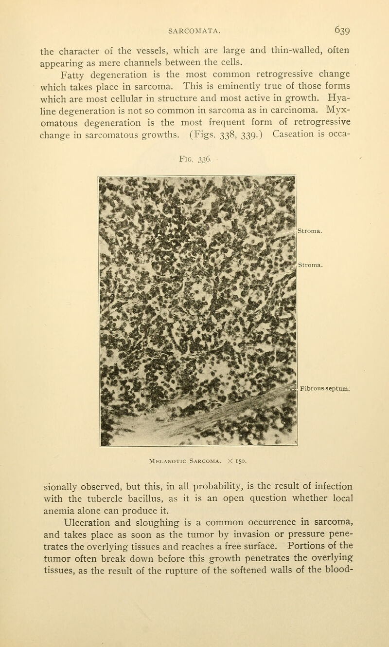 the character of the vessels, which are large and thin-walled, often appearing as mere channels between the cells. Fatty degeneration is the most common retrogressive change which takes place in sarcoma. This is eminently true of those forms which are most cellular in structure and most active in growth. Hya- line degeneration is not so common in sarcoma as in carcinoma. Myx- omatous degeneration is the most frequent form of retrogressive change in sarcomatous growths. (Figs. 338, 339.) Caseation is occa- FiG. 336. Stroma. Stroma. Fibrous septum. Melanotic Sarcoma. X 150. sionally observed, but this, in all probability, is the result of infection with the tubercle bacillus, as it is an open question whether local anemia alone can produce it. Ulceration and sloughing is a common occurrence in sarcoma, and takes place as soon as the tumor by invasion or pressure pene- trates the overlying tissues and reaches a free surface. Portions of the tumor often break down before this growth penetrates the overlying tissues, as the result of the rupture of the softened walls of the blood-