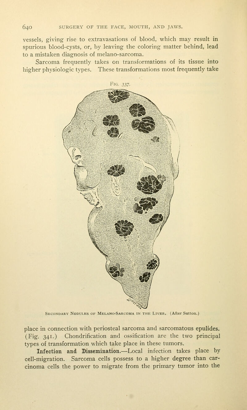 vessels, giving rise to extravasations of blood, which may result in spurious blood-cysts, or, by leaving the coloring matter behind, lead to a mistaken diagnosis of melano-sarcoma. Sarcoma frequently takes on transformations of its tissue into higher physiologic types. These transformations most frequently take Fig. 2>37- Secondary Nodules of Melano-Sarcoma in the Liver. (After Sutton.) place in connection with periosteal sarcoma and sarcomatous epulides. (Fig. 341.) Chondrification and ossification are the two principal types of transformation which take place in these tumors. Infection and Dissemination.—Local infection takes place by cell-migration. Sarcoma cells possess to a higher degree than car- cinoma cells the power to migrate from the primary tumor into the