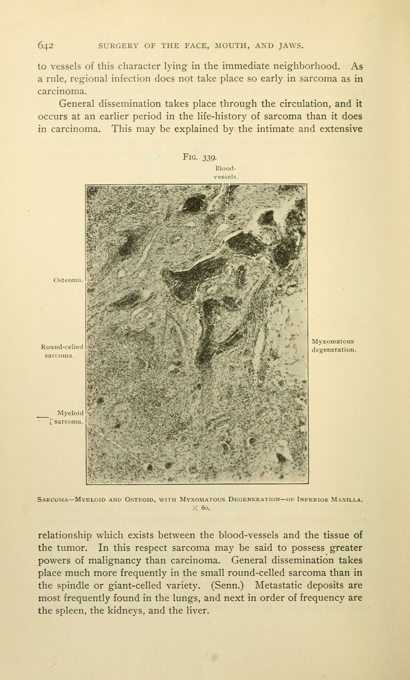 to vessels of this character lying in the immediate neighborhood. As a rule, regional infection does not take place so early in sarcoma as in carcinoma. General dissemination takes place through the circulation, and it occurs at an earlier period in the life-history of sarcoma than it does in carcinoma. This may be explained by the intimate and extensive Fig. 339. Osteoni Round-celiei sarcoma. Myeloid sarcoma. Myxomatous degeneration. ■,^^ /'•,*' Sarcoma—Myeloid and Osteoid, with Myxomatous Degeneration—of Inferior Ma.xilla. X 60. relationship which exists between the blood-vessels and the tissue of the tumor. In this respect sarcoma may be said to possess greater powers of malignancy than carcinoma. General dissemination takes place much more frequently in the small round-celled sarcoma than in the spindle or giant-celled variety. (Senn.) Metastatic deposits are most frequently found in the lungs, and next in order of frequency are the spleen, the kidneys, and the liver.