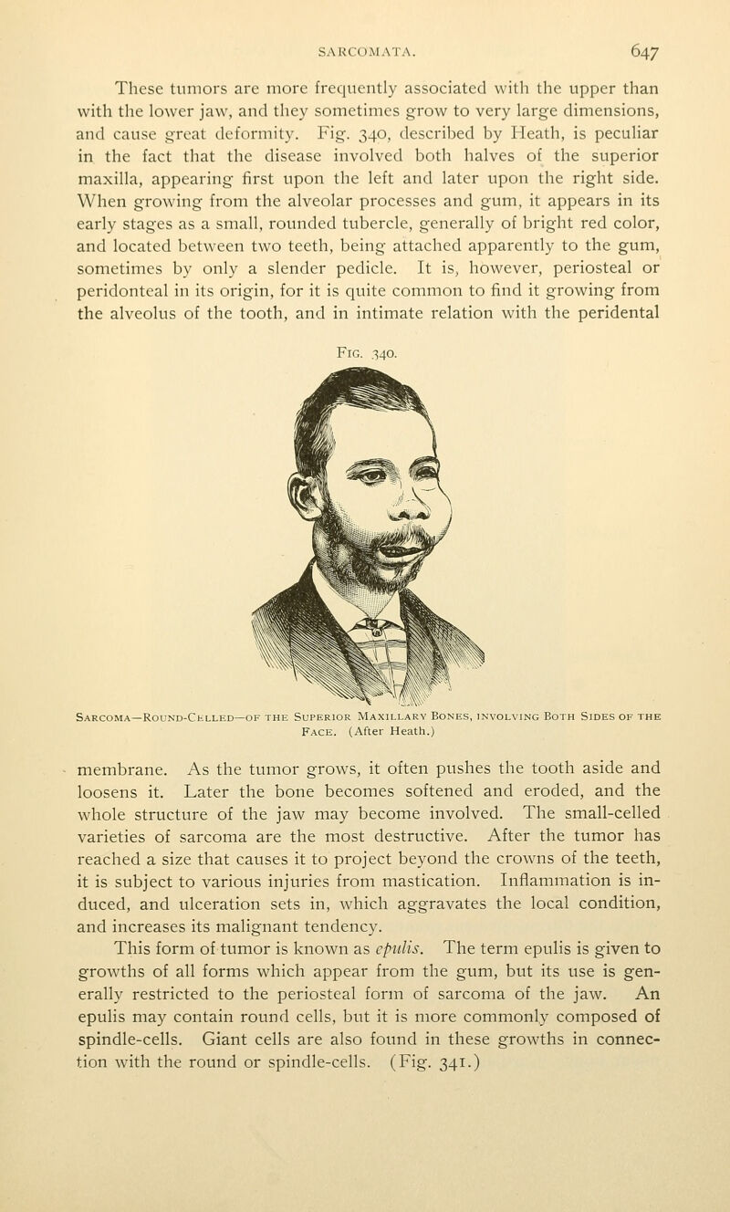 These tumors arc more frequently associated with the upper than with the lower jaw, and they sometimes grow to very large dimensions, and cause great deformity. Fig. 340, described by Heath, is peculiar in the fact that the disease involved both halves of the superior maxilla, appearing first upon the left and later upon the right side. When growing from the alveolar processes and gum, it appears in its early stages as a small, rounded tubercle, generally of bright red color, and located between two teeth, being attached apparently to the gum, sometimes by only a slender pedicle. It is, however, periosteal or peridonteal in its origin, for it is quite common to find it growing from the alveolus of the tooth, and in intimate relation with the peridental Fig. 340. Sarcoma—Round-Cklled—OF THi- Supi-rior Maxiliar\ Bonls, involving Both Sides of the Face. (After Heath.) membrane. As the tumor grows, it often pushes the tooth aside and loosens it. Later the bone becomes softened and eroded, and the whole structure of the jaw may become involved. The small-celled varieties of sarcoma are the most destructive. After the tumor has reached a size that causes it to project beyond the crowns of the teeth, it is subject to various injuries from mastication. Inflammation is in- duced, and ulceration sets in, which aggravates the local condition, and increases its malignant tendency. This form of tumor is known as epulis. The term epulis is given to growths of all forms which appear from the gum, but its use is gen- erally restricted to the periosteal form of sarcoma of the jaAV. An epulis may contain round cells, but it is more commonly composed of spindle-cells. Giant cells are also found in these growths in connec- tion with the round or spindle-cells. (Fig. 341.)