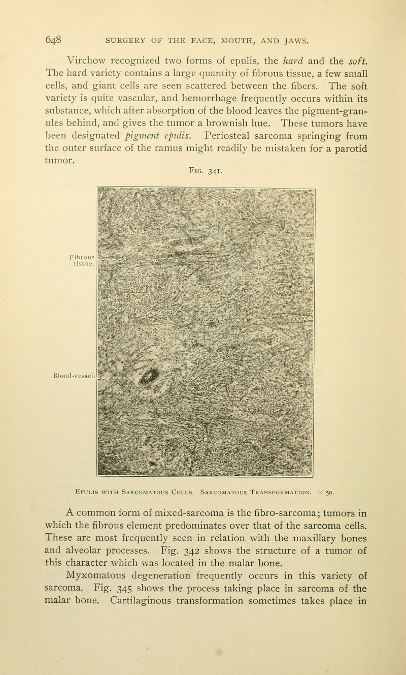 Virchow recognized two forms of epulis, the hard and the soft. The hard variety contains a large quantity of fibrous tissue, a few small cells, and giant cells are seen scattered between the fibers. The soft variety is quite vascular, and hemorrhage frequently occurs within its substance, which after absorption of the blood leaves the pigment-gran- ules behind, and gives the tumor a brownish hue. These tumors have been designated pigment epulis. Periosteal sarcoma springing from the outer surface of the ramus might readily be mistaken for a parotid tumor. Fig. 341. Fibrous tissue. Blood-vessel. .iasuSSi-trft*? Epulis with Sarcomatous Cells. Sarcomatous Transformation. A common form of mixed-sarcoma is the fibro-sarcoma; tumors in which the fibrous element predominates over that of the sarcoma cells. These are most frequently seen in relation with the maxillary bones and alveolar processes. Fig. 342 shows the structure of a tumor of this character which was located in the malar bone. Myxomatous degeneration frequently occurs in this variety of sarcoma. Fig. 345 shows the process taking place in sarcoma of the malar bone. Cartilaginous transformation sometimes takes place in