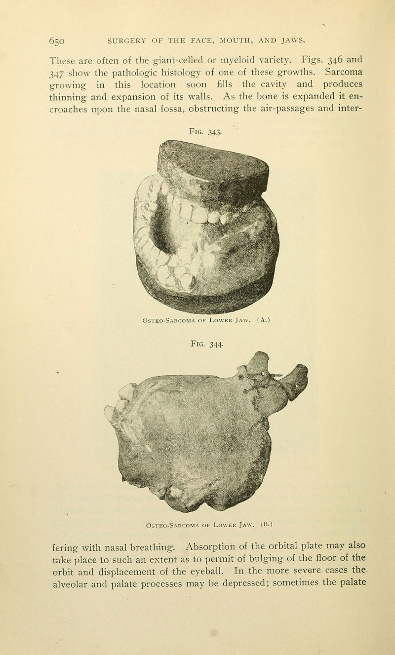 These are often of the giant-celled or myeloid variety. Figs. 346 and 347 show the pathologic histology of one of these growths. Sarcoma growing in this location soon fills the cavity and produces thinning and expansion of its walls. As the bone is expanded it en- croaches upon the nasal fossa, obstructing the air-passages and inter- FiG. 343. Osteo-Sarcoma of Lower Jaw. (A.) Fig. 344. Osteo-Sarcoma of Lower Jaw. (B. fering with nasal breathing. Absorption of the orbital plate may also take place to such an extent as to permit of bulging of the floor of the orbit and displacement of the eyeball. In the more severe cases the alveolar and palate processes may be depressed; sometimes the palate