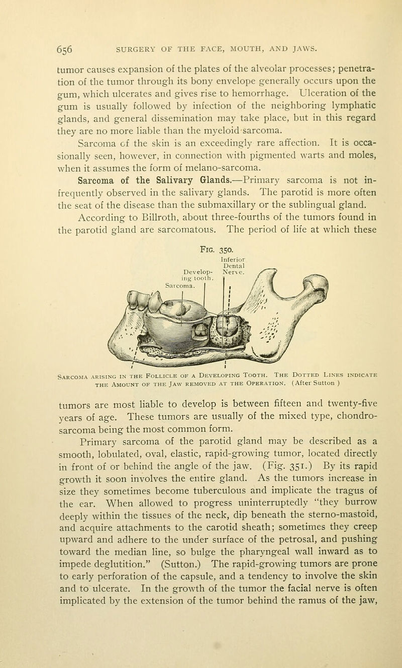 tumor causes expansion of the plates of the alveolar processes; penetra- tion of the tumor through its bony envelope generally occurs upon the gum, which ulcerates and gives rise to hemorrhage. Ulceration of the gum is usually followed by infection of the neighboring lymphatic glands, and general dissemination may take place, but in this regard they are no more liable than the myeloid sarcoma. Sarcoma of the skin is an exceedingly rare affection. It is occa- sionally seen, however, in connection with pigmented warts and moles, when it assumes the form of melano-sarcoma. Sarcoma of the Salivary Glands.—Primary sarcoma is not in- frequently observed in the salivary glands. The parotid is more often the seat of the disease than the submaxillary or the sublingual gland. According to Billroth, about three-fourths of the tumors found in the parotid gland are sarcomatous. The period of life at which these Sarcoma arising in the Follicle of a Developing Tooth. The Dotted Lines indicate THE Amount of the Jaw removed at the Operation. (After Sutton ) tumors are most liable to develop is between fifteen and twenty-five years of age. These tumors are usually of the mixed type, chondro- sarcoma being the most common form. Primary sarcoma of the parotid gland may be described as a smooth, lobulated, oval, elastic, rapid-growing tumor, located directly in front of or behind the angle of the jaw. (Fig. 351.) By its rapid growth it soon involves the entire gland. As the tumors increase in size they sometimes become tuberculous and implicate the tragus of the ear. When allowed to progress uninterruptedly they burrow deeply within the tissues of the neck, dip beneath the sterno-mastoid, and acquire attachments to the carotid sheath; sometimes they creep upward and adhere to the under surface of the petrosal, and pushing toward the median line, so bulge the pharyngeal wall inward as to impede deglutition. (Sutton.) The rapid-growing tumors are prone to early perforation of the capsule, and a tendency to involve the skin and to ulcerate. In the growth of the tumor the facial nerve is often implicated by the extension of the tumor behind the ramus of the jaw.