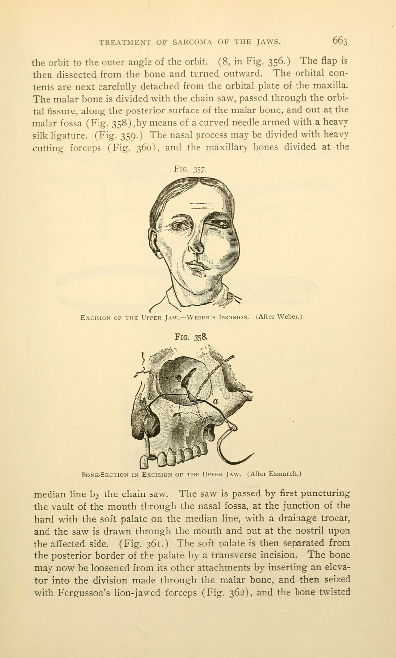 the orbit to the outer angle of the orbit. (8, in Fig. 356.) The flap is then dissected from the bone and turned outward. The orbital con- tents are next carefully detached from the orbital plate of the maxilla. The malar bone is divided with the chain saw, passed through the orbi- tal fissure, along the posterior surface of the malar bone, and out at the malar fossa (Fig. 358),by means of a curved needle armed with a heavy silk ligature. (Fig. 359.) The nasal process may be divided with heavy cutting forceps (Fig. 360). and the maxillary bones divided at the Fig Excision of the Upper Jaw.—Weber's Incision. i,After Weber.) Fig. 358. Bone-Section in Excision of the Upper Jaw. (After Esmarch.) median line by the chain saw. The saw is passed by first puncturing the vault of the mouth through the nasal fossa, at the junction of the hard with the soft palate on the median line, with a drainage trocar, and the saw is drawn through the mouth and out at the nostril upon the affected side. (Fig. 361.) The soft palate is then separated from the posterior border of the palate by a transverse incision. The bone may now be loosened from its other attachments by inserting an eleva- tor into the division made through the malar bone, and then seized with Fergusson's lion-jawed forceps (Fig. 362), and the bone twisted