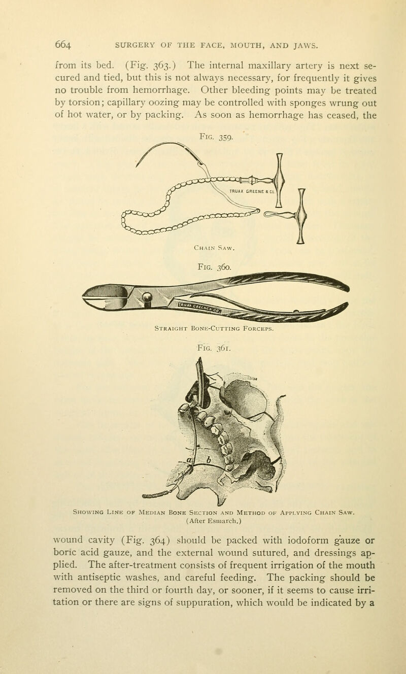 from its bed. (Fig-. 363.) The internal maxillary artery is next se- cured and tied, but this is not always necessary, for frequently it gives no trouble from hemorrhage. Other bleeding points may be treated by torsion; capillary oozing may be controlled with sponges wrung out of hot water, or by packing. As soon as hemorrhage has ceased, the Fig. 359. ChaiiN Saw. Fig. 360. Straight Bone-Cutting Forceps. Fig. 361. Showing Line of Median Bone Section a.md Method of Applying Chain Saw. (After Esniarch.) W'ound cavity (Fig. 364) should be packed with iodoform gauze or boric acid gauze, and the external wound sutured, and dressings ap- plied. The after-treatment consists of frequent irrigation of the mouth with antiseptic washes, and careful feeding. The packing should be removed on the third or fourth day, or sooner, if it seems to cause irri- tation or there are signs of suppuration, which would be indicated by a