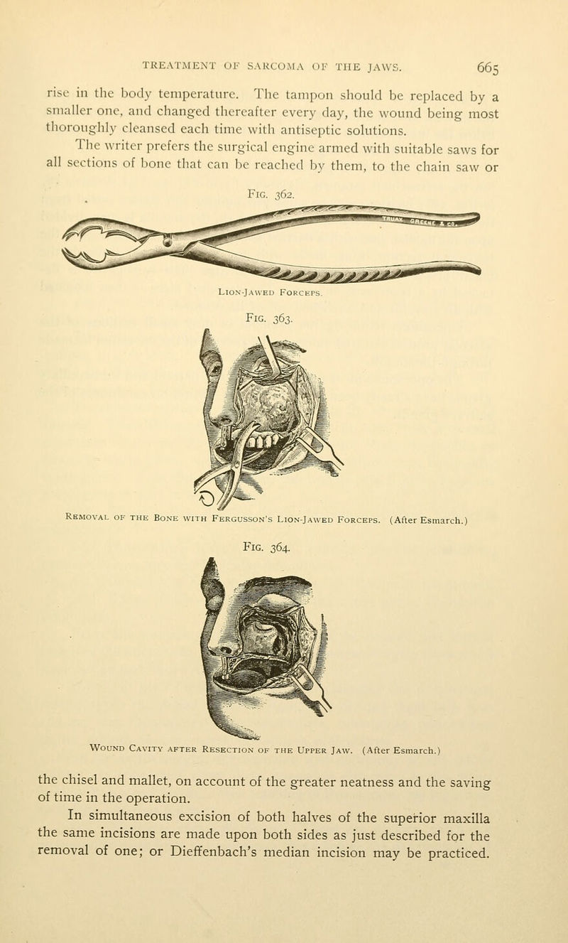 rise in the body temperature. The tampon should be replaced by a smaller one, and changed thereafter every day, the wound being most thoroughly cleansed each time with antiseptic solutions. The writer prefers the surgical engine armed with suitable saws for all sections of bone that can be reached by them, to the chain saw or Fig. :!)62. Lion-Jawed Forceps. Fig. 363. Removal of the Bone with Fergusson's Lion-Jawed Forceps. (After Esmarch.) Fig. 364. Wound Cavity after Resection of the Upper Jaw. (After Esmarch.) the chisel and mallet, on account of the greater neatness and the saving of time in the operation. In simultaneous excision of both halves of the superior maxilla the same incisions are made upon both sides as just described for the removal of one; or Dieffenbach's median incision may be practiced.