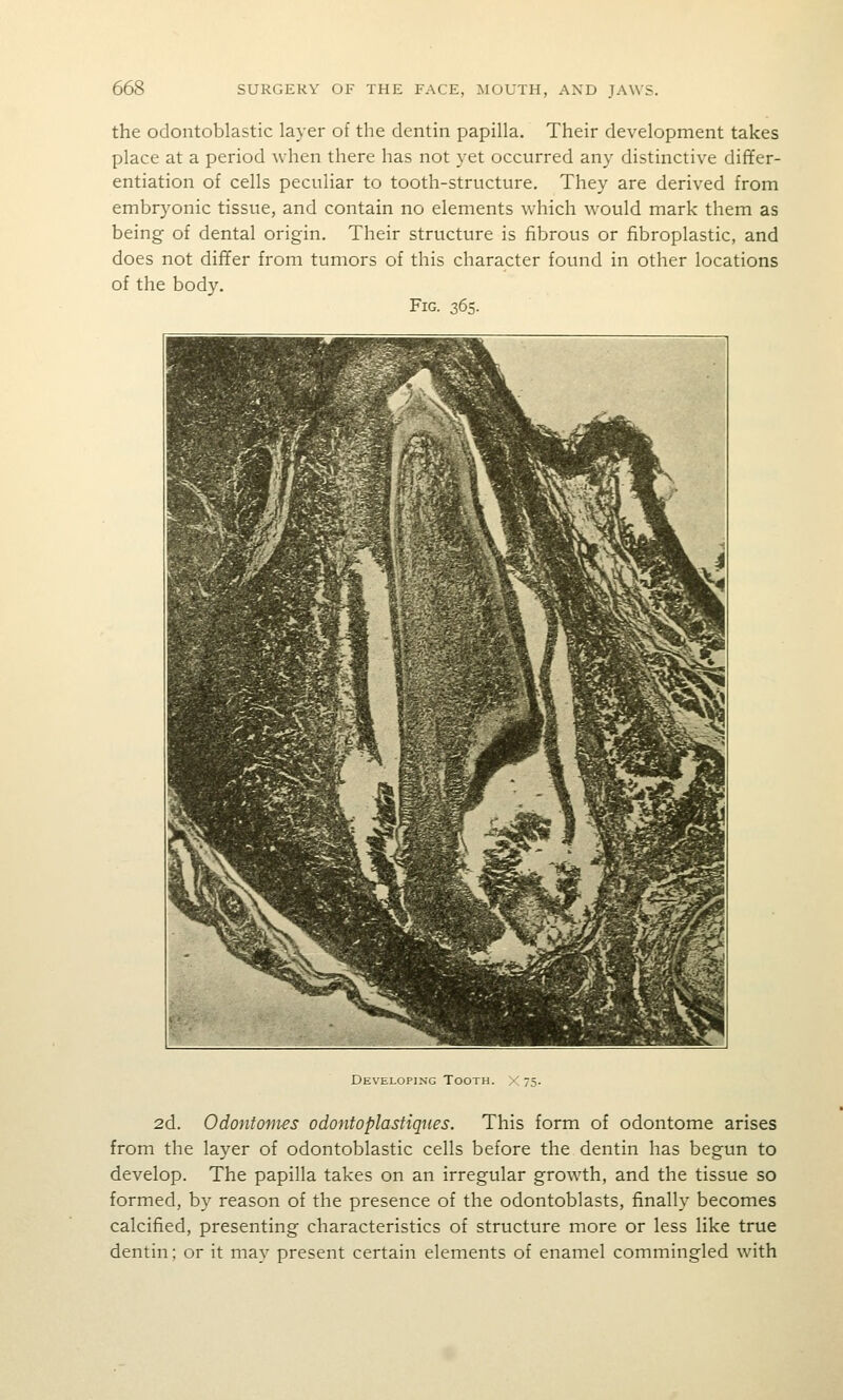 the odontoblastic layer of the dentin papilla. Their development takes place at a period when there has not yet occurred any distinctive differ- entiation of cells peculiar to tooth-structure. They are derived from embryonic tissue, and contain no elements which would mark them as being of dental origin. Their structure is fibrous or fibroplastic, and does not differ from tumors of this character found in other locations of the body. Fig. 365. ■ ■ 1 i ■ 1 H^^^^^^k ^^ t^ B mx m II 1 ■ ^^BHttPi^ .</BLA ' %> ^H9 ffipyns 1^^ HK^ B PI l^Mttyf'-^^ e VL jHB ^Bd^C^w/b ^^k S|| B nLa^BS^S^^ l^m H ^j M F 1 ^y 1 B m •| ^^^9 K 1 1 I 1 1 m |Wh^jV-•v^^%wq m f 5 1 1 itH m Developing Tooth. 2d. Odontonves odontoplastiques. This form of odontome arises from the layer of odontoblastic cells before the dentin has begun to develop. The papilla takes on an irregular growth, and the tissue so formed, by reason of the presence of the odontoblasts, finally becomes calcified, presenting characteristics of structure more or less like true dentin; or it may present certain elements of enamel commingled with