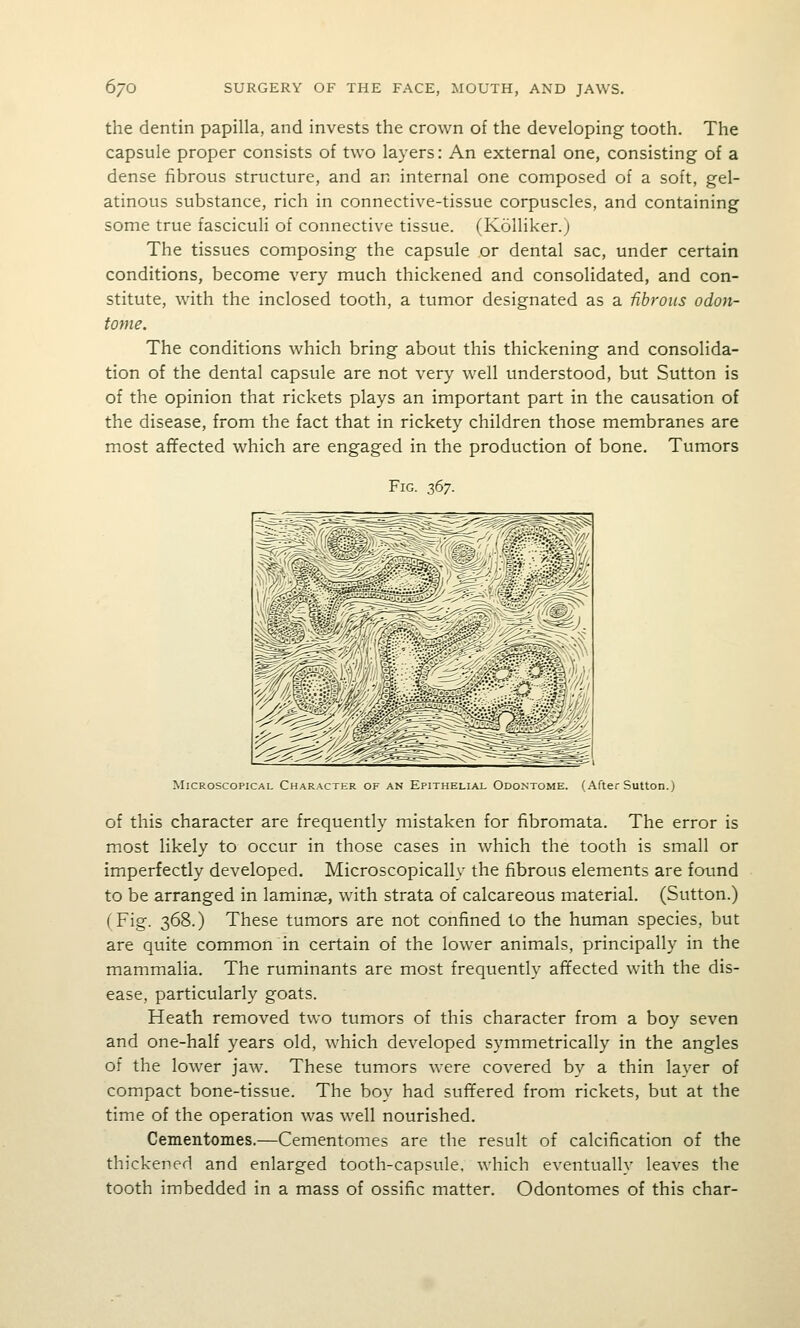 the dentin papilla, and invests the crown of the developing tooth. The capsule proper consists of two layers: An external one, consisting of a dense fibrous structure, and an internal one composed of a soft, gel- atinous substance, rich in connective-tissue corpuscles, and containing some true fasciculi of connective tissue. (Kolliker.j The tissues composing the capsule or dental sac, under certain conditions, become very much thickened and consolidated, and con- stitute, with the inclosed tooth, a tumor designated as a fibrous odon- tome. The conditions which bring about this thickening and consolida- tion of the dental capsule are not very well understood, but Sutton is of the opinion that rickets plays an important part in the causation of the disease, from the fact that in rickety children those membranes are most affected which are engaged in the production of bone. Tumors Fig. 2>^7. '--- '^rr '~5^ Microscopical Character of an Epithelial Odqntome. (After Sutton.) of this character are frequently mistaken for fibromata. The error is most likely to occur in those cases in which the tooth is small or imperfectly developed. Microscopically the fibrous elements are found to be arranged in laminae, with strata of calcareous material. (Sutton.) (Fig. 368.) These tumors are not confined to the human species, but are quite common in certain of the lower animals, principally in the mammalia. The ruminants are most frequently affected with the dis- ease, particularly goats. Heath removed two tumors of this character from a boy seven and one-half years old, which developed symmetrically in the angles of the lower jaw. These tumors were covered by a thin layer of compact bone-tissue. The boy had suffered from rickets, but at the time of the operation was well nourished. Cementomes.—Cementomes are the result of calcification of the thickened and enlarged tooth-capsule, which eventually leaves the tooth imbedded in a mass of ossific matter. Odontomes of this char-