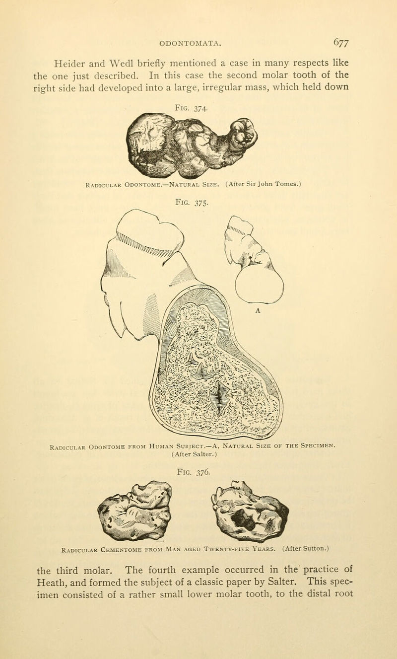 Heider and Wedl briefly mentioned a case in many respects like the one just described. In this case the second molar tooth of the right side had developed into a large, irregular mass, which held down Fig. 374. Radicular Odontome.—Natural Size. (After Sir John Tomes.) Fig. 375. Radicular Odontome from Human Subject.—A, Natural Size of the Specimen. (After Salter.) Fig. 376. Radicular Cementome from Man aged Twenty-five Years. (After Sutton.) the third molar. The fourth example occurred in the practice of Heath, and formed the subject of a classic paper by Salter, This spec- imen consisted of a rather small lower molar tooth, to the distal root