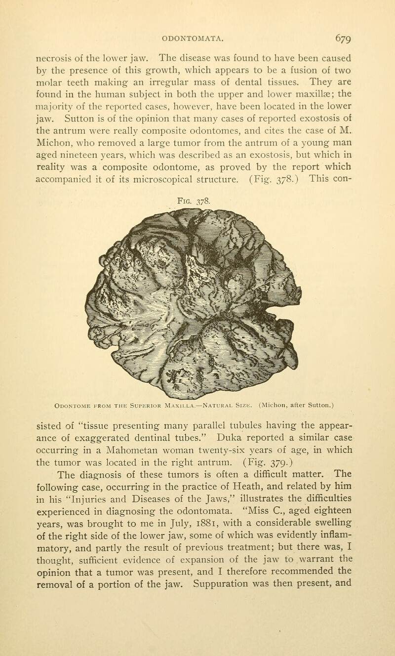 necrosis of the lower jaw. The disease was found to have been caused by the presence of this growth, which appears to be a fusion of two molar teeth making an irregular mass of dental tissues. They are found in the human subject in both the upper and lower maxillae; the majority of the reported cases, however, have been located in the lower jaw. Sutton is of the opinion that many cases of reported exostosis of the antrum were really composite odontomes, and cites the case of M. Michon, who removed a large tumor from the antrum of a young man aged nineteen years, which was described as an exostosis, but which in reality was a composite odontome, as proved by the report which accompanied it of its microscopical structure. (Fig. 3/8.) This con- FiG. 378. Odontome from the Superior Maxii.la.—Natural Sizii. (Michoii, after Sutton.) sisted of tissue presenting many parallel tubules having the appear- ance of exaggerated dentinal tubes. Duka reported a similar case occurring in a Mahometan woman twenty-six years of age, in which the tumor was located in the right antrum. (Fig. 379.) The diagnosis of these tumors is often a difficult matter. The following case, occurring in the practice of Heath, and related by him in his Injuries and Diseases of the Jaws, illustrates the difficulties experienced in diagnosing the odontomata. Miss C, aged eighteen years, was brought to me in July, 1881, with a considerable swelling of the right side of the lower jaw, some of which was evidently inflam- matory, and partly the result of previous treatment; but there was, I thought, sufficient evidence of expansion of the jaw to .warrant the opinion that a tumor was present, and I therefore recommended the removal of a portion of the jaw. Suppuration was then present, and