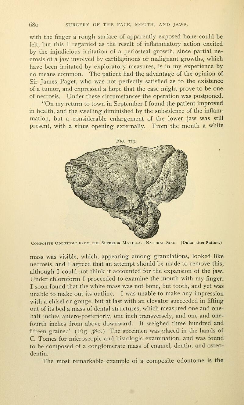 with the finger a rough surface of apparently exposed bone could be felt, but this I regarded as the result of inflammatory action excited by the injudicious irritation of a periosteal growth, since partial ne- crosis of a jaw involved by cartilaginous or malignant growths, which have been irritated by exploratory measures, is in my experience by no means common. The patient had the advantage of the opinion of Sir James Paget, who was not perfectly satisfied as to the existence of a tumor, and expressed a hope that the case might prove to be one of necrosis. Under these circumstances the operation was postponed. On my return to town in September I found the patient improved in health, and the swelling diminished by the subsidence of the inflam- mation, but a considerable enlargement of the lower jaw was still present, with a sinus opening externally. From the mouth a white Fig ^^79 Composite Odontome from the Superior Maxilla.—Natural Size. (Duka, after Sutton.) mass was visible, which, appearing among granulations, looked like necrosis, and I agreed that an attempt should be made to remove this, although I could not think it accounted for the expansion of the jaw. Under chloroform I proceeded to examine the mouth with my finger. I soon found that the white mass was not bone, but tooth, and yet was unable to make out its outline. I was unable to make any impression with a chisel or gouge, but at last with an elevator succeeded in lifting out of its bed a mass of dental structures, which measured one and one- half inches antero-posteriorly, one inch transversely, and one and one- fourth inches from above downward. It weighed three hundred and fifteen grains. (Fig. 380.) The specimen was placed in the hands of C. Tomes for microscopic and histologic examination, and was found to be composed of a conglomerate mass of enamel, dentin, and osteo- dentin. The most remarkable example of a composite odontome is the