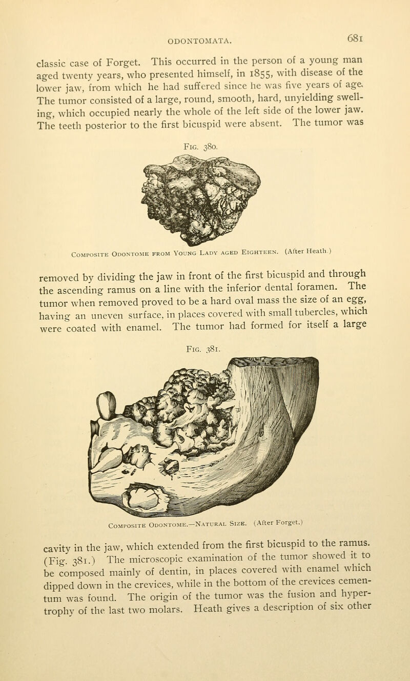 classic case of Forget. This occurred in the person of a young man aged twenty years, who presented himself, in 1855, with disease of the lower jaw, from which he had sufifered since he was five years of age. The tumor consisted of a large, round, smooth, hard, unyielding swell- ing, which occupied nearly the whole of the left side of the lower jaw. The teeth posterior to the first bicuspid were absent. The tumor was Composite Odontome from Young Lady aged Eighteen. (After Heath ) removed by dividing the jaw in front of the first bicuspid and through the ascending ramus on a line with the inferior dental foramen. The tumor when removed proved to be a hard oval mass the size of an egg, having an uneven surface, in places covered with small tubercles, which were coated with enamel. The tumor had formed for itself a large Composite Odontome—Natural Size. (After Forget.) cavity in the jaw, which extended from the first bicuspid to the ramus. (Fig. 381.) The microscopic examination of the tumor showed it to be Composed mainlv of dentin, in places covered with enamel which dipped down in the crevices, while in the bottom of the crevices cemen- tum was found. The origin of the tumor was the fusion and hyper- trophv of the last two molars. Heath gives a description of six other