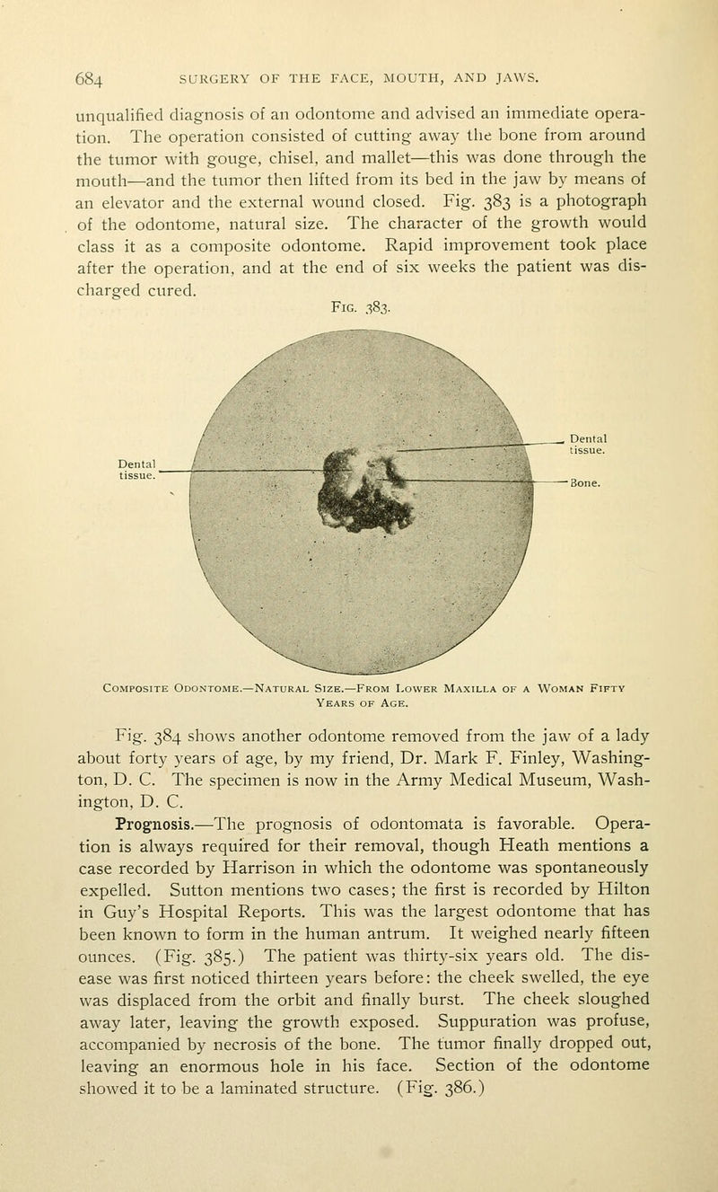 unqualified diagnosis of an odontome and advised an immediate opera- tion. The operation consisted of cutting away the bone from around the tumor with gouge, chisel, and mallet—this was done through the mouth—and the tumor then lifted from its bed in the jaw by means of an elevator and the external wound closed. Fig. 383 is a photograph of the odontome, natural size. The character of the growth would class it as a composite odontome. Rapid improvement took place after the operation, and at the end of six weeks the patient was dis- charged cured. Fig. 383. Composite Odontome. -Natural Size.—P'rom Lower Maxilla of a Woman Fifty Years of Age. Fig. 384 shows another odontome removed from the jaw of a lady about forty years of age, by my friend. Dr. Mark F. Finley, Washing- ton, D. C. The specimen is now in the Army Medical Museum, Wash- ington, D. C. Prognosis.—The prognosis of odontomata is favorable. Opera- tion is always required for their removal, though Heath mentions a case recorded by Harrison in which the odontome was spontaneously expelled. Sutton mentions two cases; the first is recorded by Hilton in Guy's Hospital Reports. This was the largest odontome that has been known to form in the human antrum. It weighed nearly fifteen ounces. (Fig. 385.) The patient was thirty-six years old. The dis- ease was first noticed thirteen years before: the cheek swelled, the eye was displaced from the orbit and finally burst. The cheek sloughed away later, leaving the growth exposed. Suppuration was profuse, accompanied by necrosis of the bone. The tumor finally dropped out, leaving an enormous hole in his face. Section of the odontome showed it to be a laminated structure. (Fig. 386.)