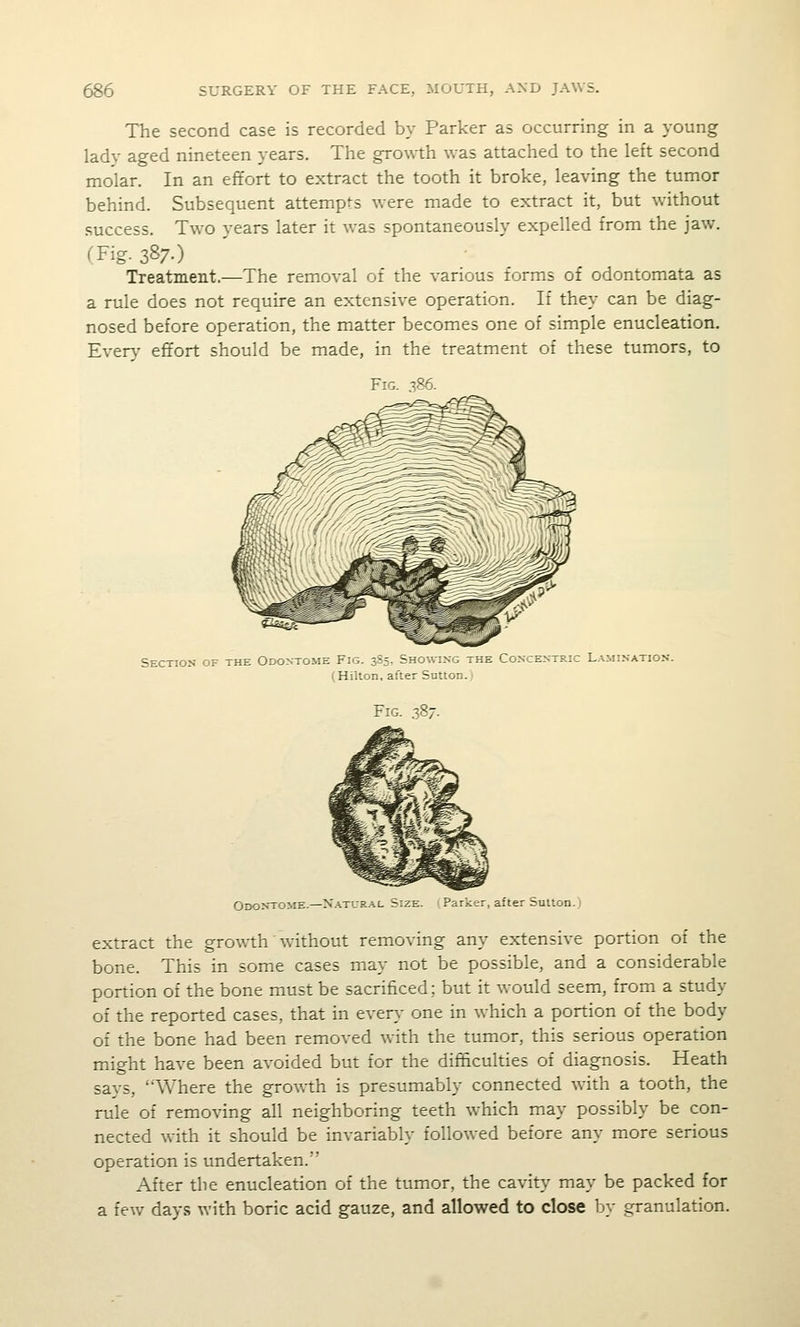 The second case is recorded by Parker as occurring in a young lady aged nineteen years. The growth was attached to the left second molar. In an effort to extract the tooth it broke, leaving the tumor behind. Subsequent attempts were made to extract it, but without .success. Two years later it was spontaneously expelled from the jaw. (Fig. 387-) Treatment.—The removal of the various forms of odontomata as a rule does not require an extensive operation. If they can be diag- nosed before operation, the matter becomes one of simple enucleation. Everv effort should be made, in the treatment of these tumors, to Fig. .386. Section of the Odontome Fig. 3S5. Shov.inc tks Concentric L.a.mination. (Hilton, after Sutton.) Fig. 38/- Odontome.—X.A.TUR-A.L Size. (Parker, after Suiton.) extract the growth without removing any extensive portion of the bone. This in some cases may not be possible, and a considerable portion of the bone must be sacrificed; but it would seem, from a study of the reported cases, that in every one in which a portion of the body of the bone had been removed with the tumor, this serious operation might have been avoided but for the difffculties of diagnosis. Heath says, Where the growth is presumably connected with a tooth, the rule of removing all neighboring teeth which may possibly be con- nected with it should be invariably followed before any more serious operation is undertaken. After the enucleation of the tumor, the cavity may be packed for a few days with boric acid gauze, and allowed to close by granulation.