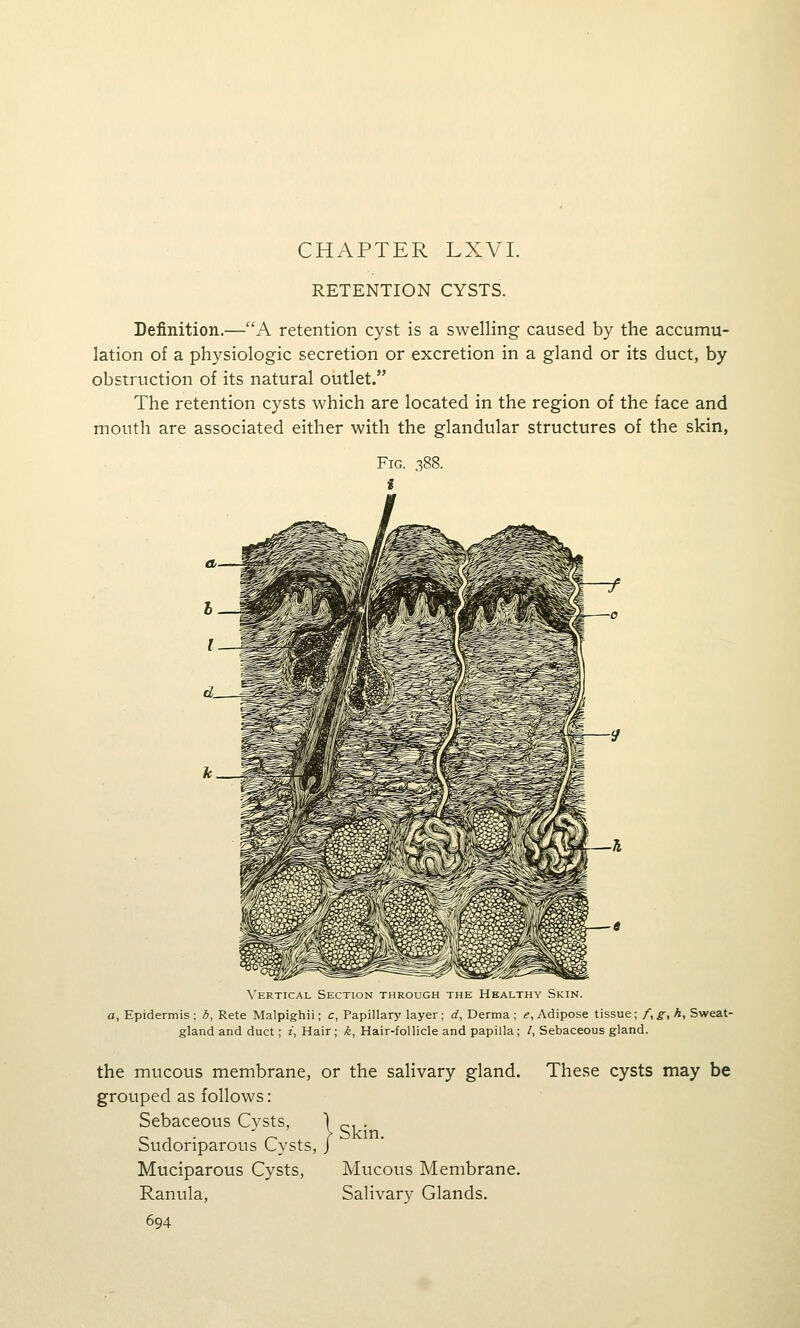 CHAPTER LXVI. RETENTION CYSTS. Definition.—A retention cyst is a swelling caused by the accumu- lation of a physiologic secretion or excretion in a gland or its duct, by obstruction of its natural outlet. The retention cysts which are located in the region of the face and mouth are associated either with the glandular structures of the skin, Vertical Section through the Healthy Skin. a, Epidermis ; b, Rete Malpighii; c, Papillary layer ; d, Derma ; e, Adipose tissue ; /, £-, k, Sweat- gland and duct; z, Hair; k, Hair-follicle and papilla; /, Sebaceous gland. the mucous membrane, or the salivary gland grouped as follows: Sebaceous Cysts, Sudoriparous Cysts, Muciparous Cysts, Ranula, 694 These cysts may be Skin. Mucous Membrane. Salivary Glands.