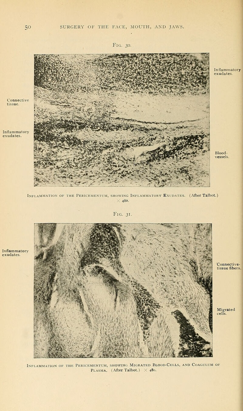 Fl W •T^ ri-''^ i^^^^i^J^^-'^ .- Inflammation of the Pericementum, showing Inflammatory Exll Fig. 31. Inflammation of the Pericementum, showing Migrated Blood-Cells, and Coagulum of Plasma. (After Talbot.) X 480.